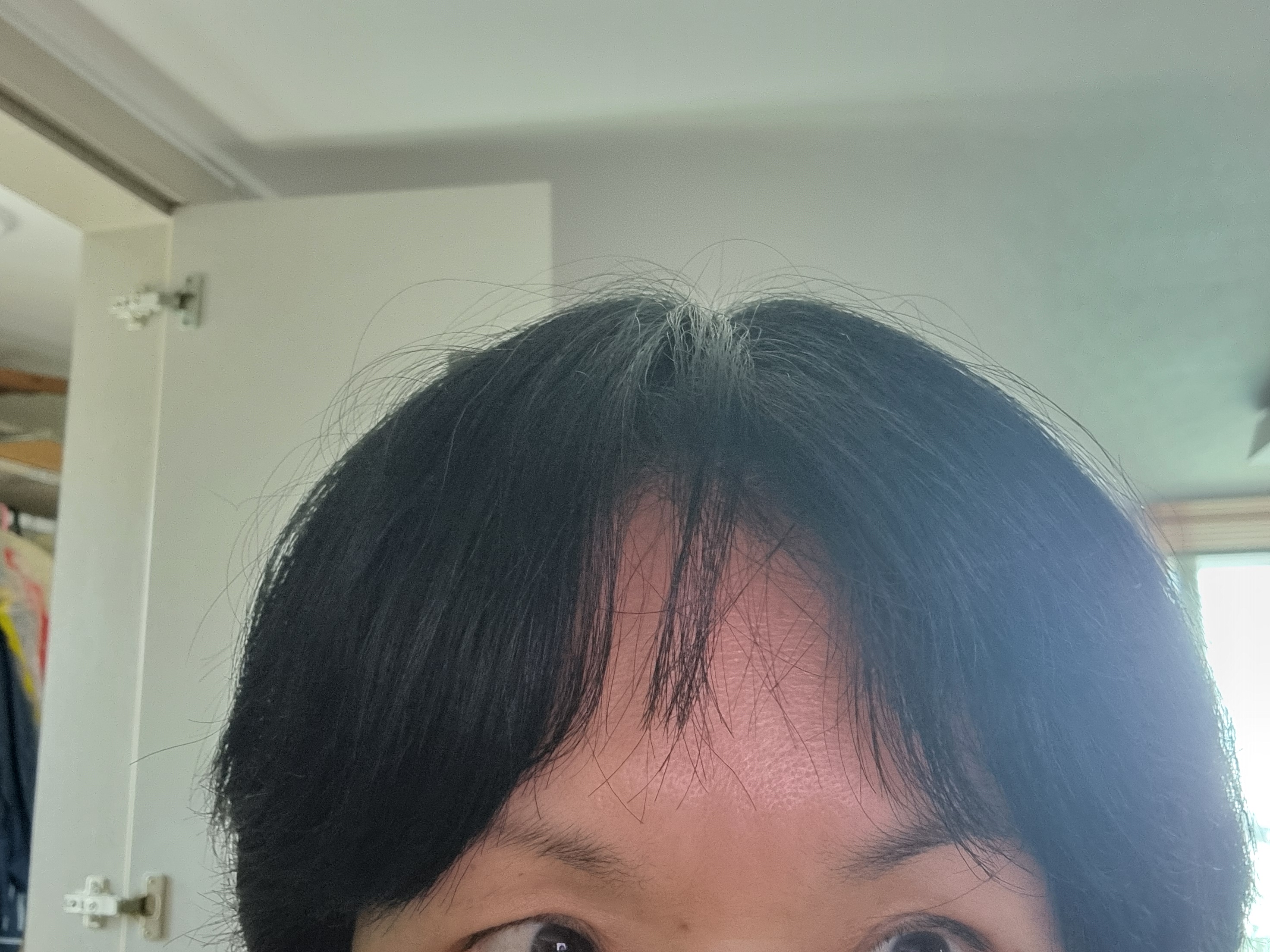 천안 메이퓨어의원에서 보톡스로 주름 예방 성공!