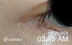 고양시 클린업피부과에서 눈가 점 제거 후 만족해요!