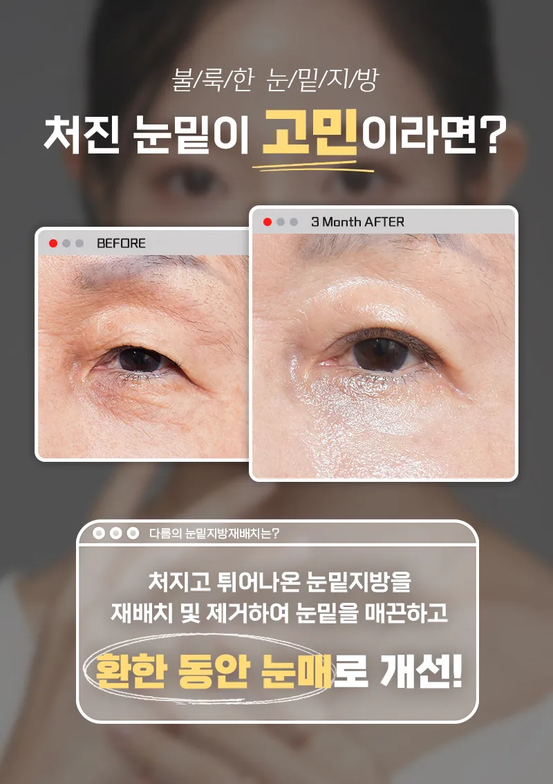 다름성형외과 어두운 눈밑은? 다름 눈밑지방재배치 이벤트, 시술 상세 이미지