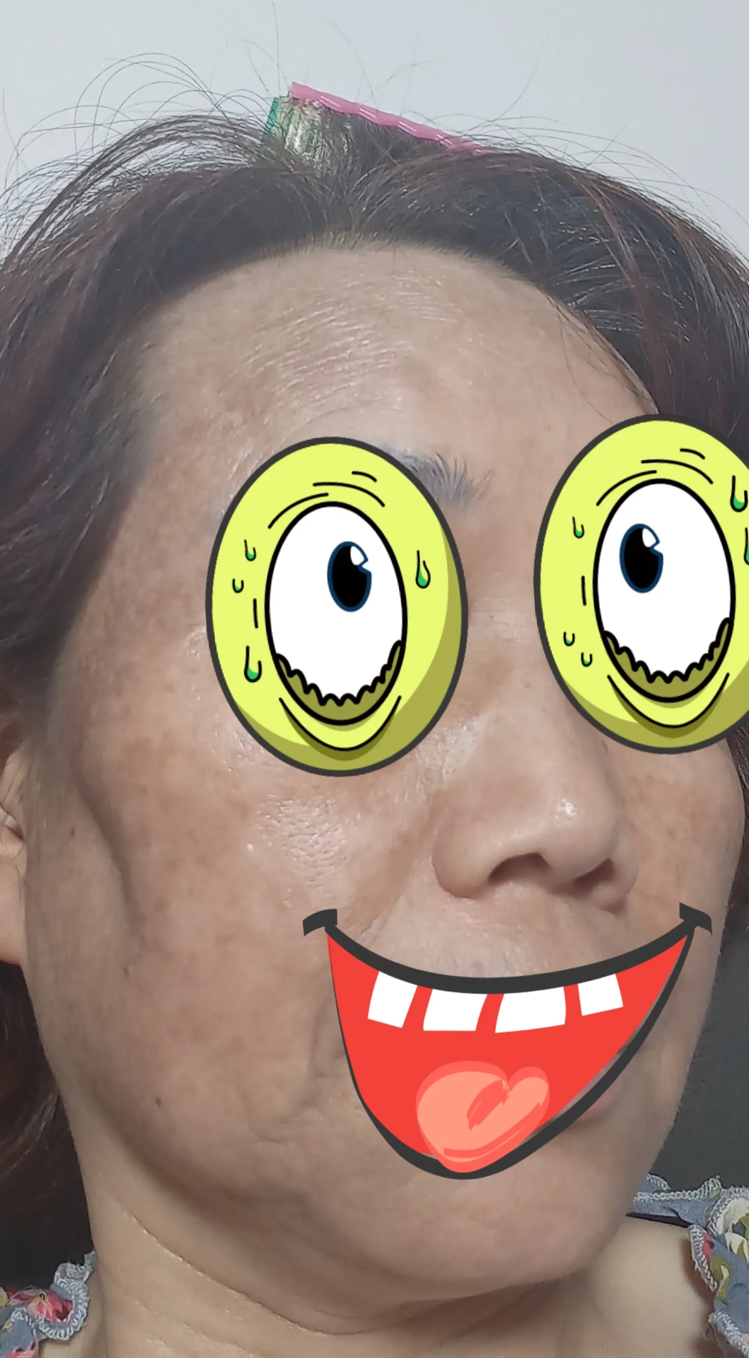 시술 전 — [잡티지우개]에이톤레이저