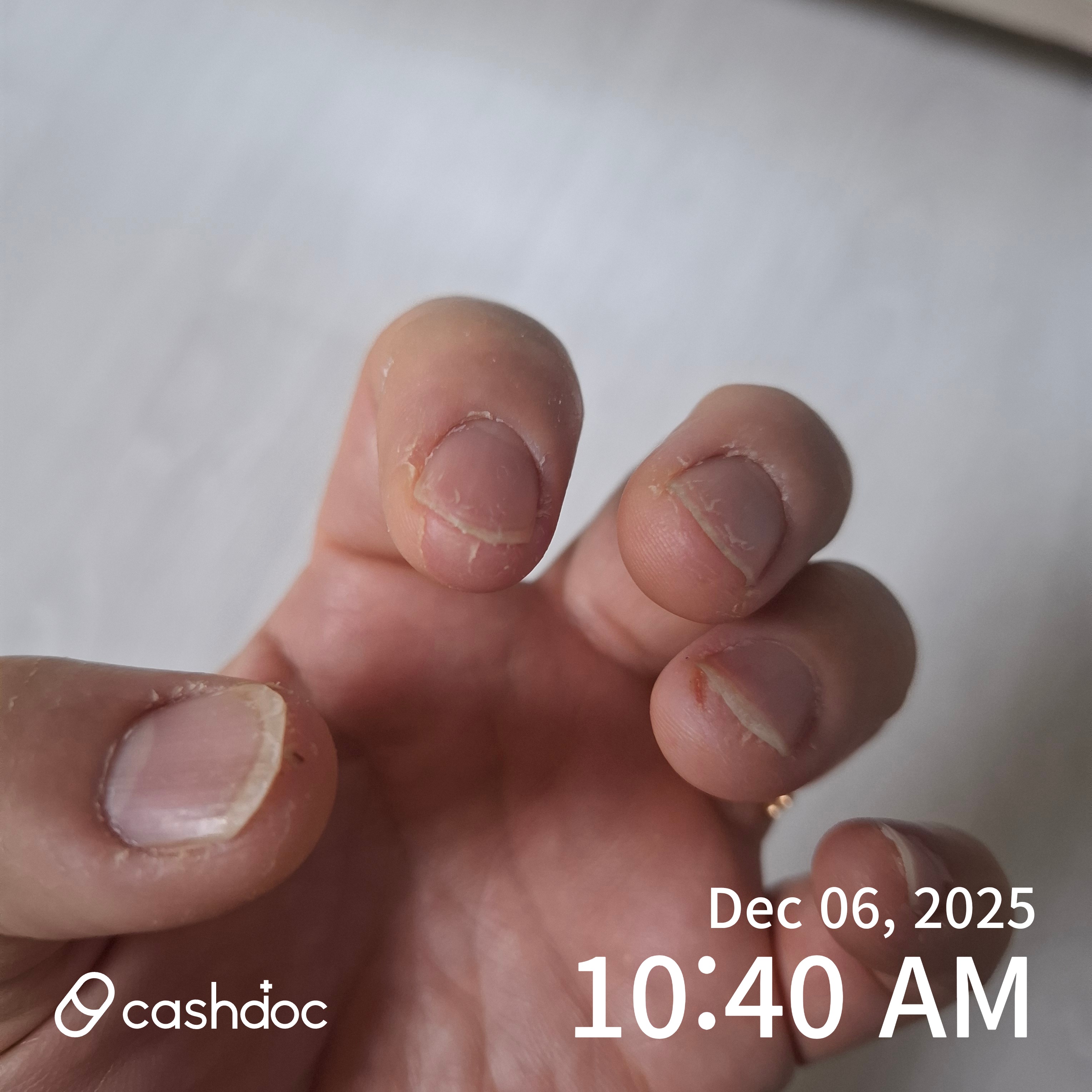 경상남도 참조은피부과의원에서 받은 친절한 진료가 네일아트 후유증을 어떻게 해결했나요?