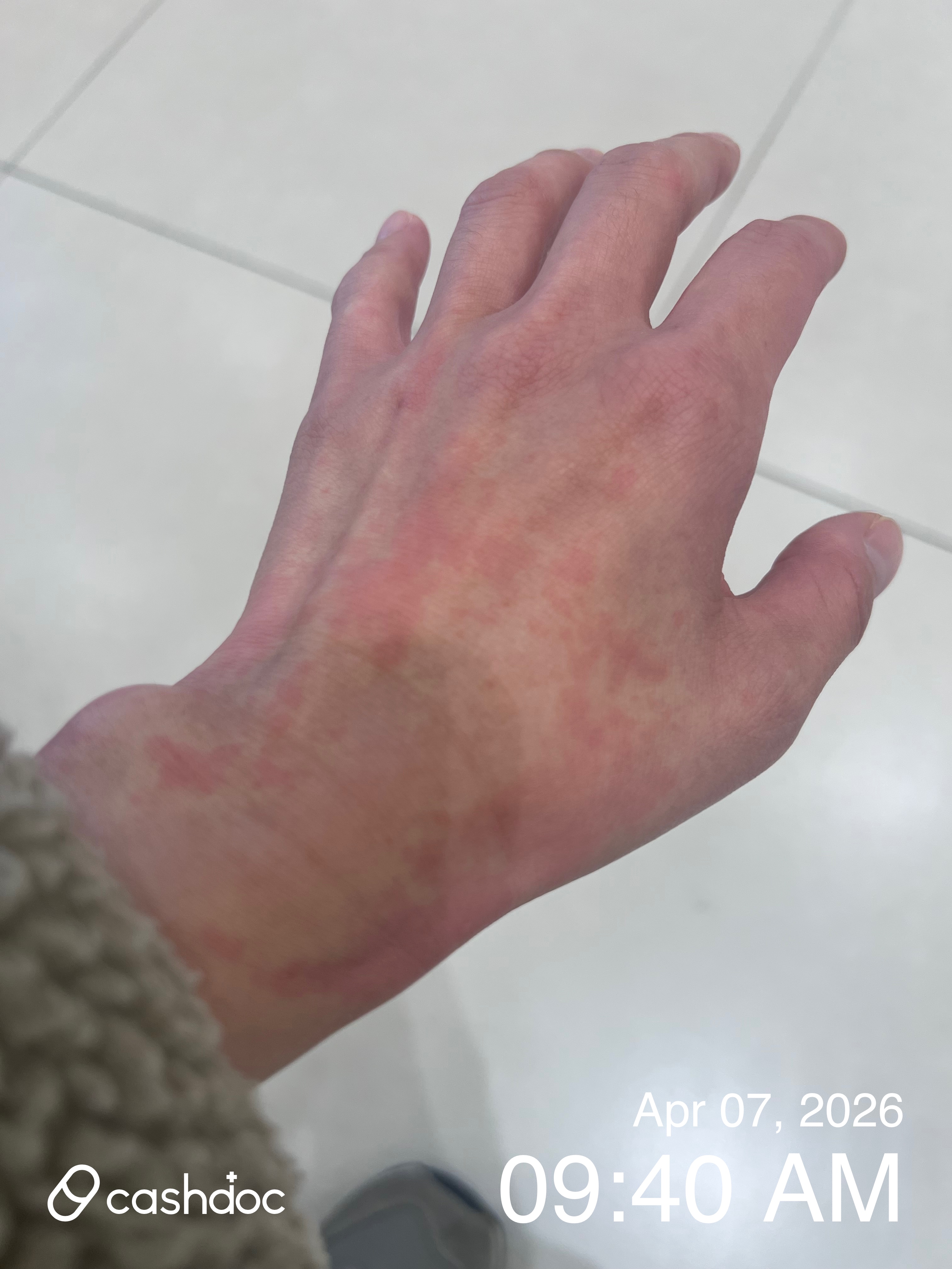 광주시 마이클래식피부과에서 알러지 증상 빠르게 진정됐어요