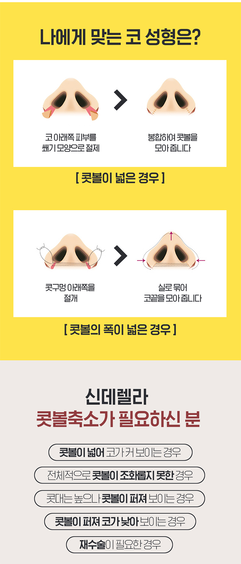 신데렐라성형외과의원 ❤신데렐라 콧볼축소❤ 이벤트, 시술 상세 이미지