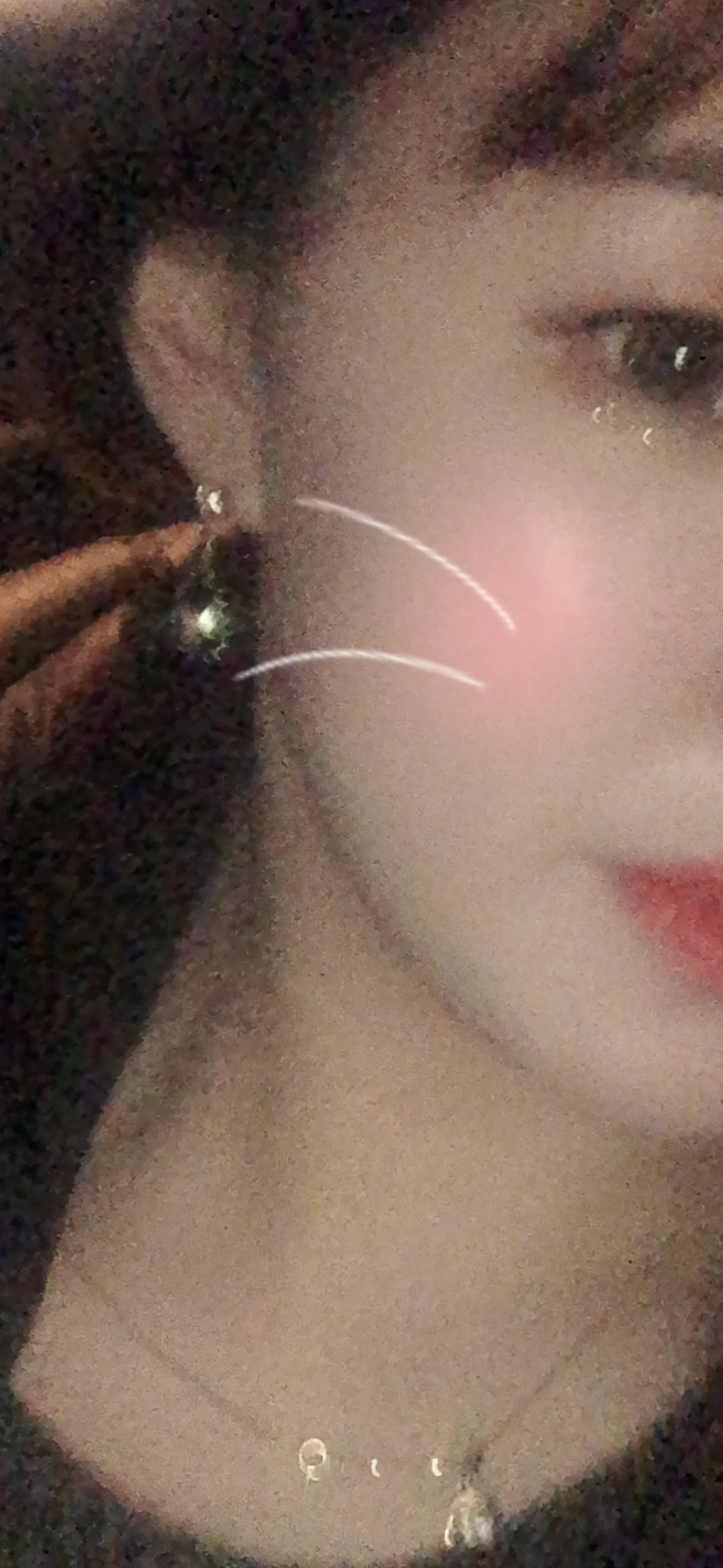 시술 후 — 튀어나온 턱라인 정리. 침샘보톡스