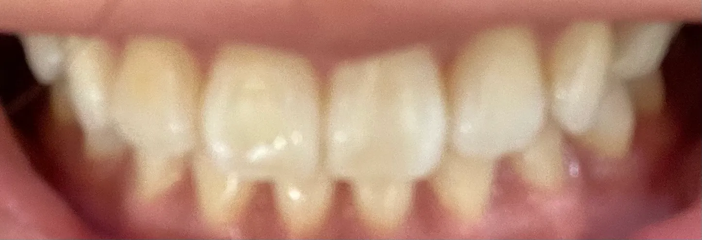 Before treatment — 30-Minute Complete Teeth Whitening Program