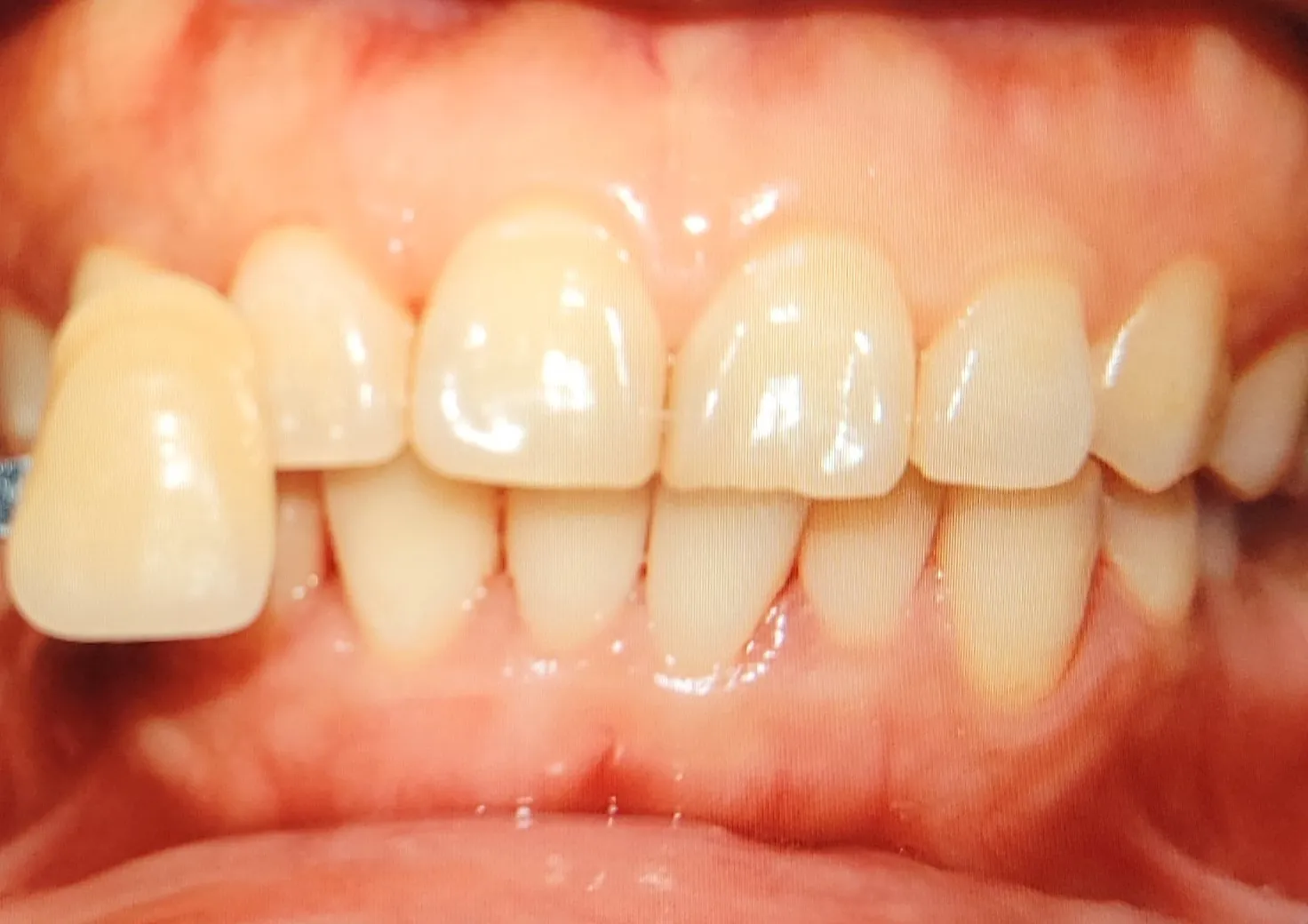 Before treatment — 30-Minute Complete Teeth Whitening Program