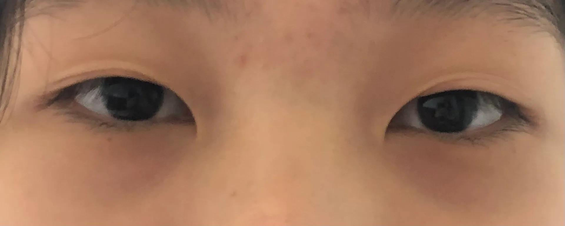 시술 전 — 눈성형~ 또렷하게 예쁜눈 