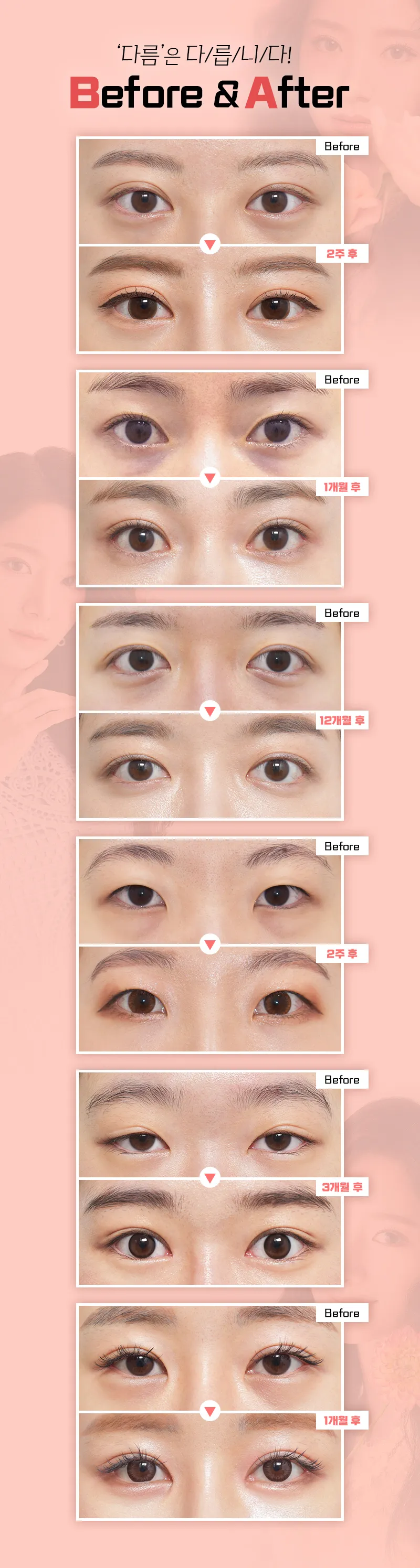 다름성형외과 어두운 눈밑은? 다름 눈밑지방재배치 이벤트, 시술 상세 이미지