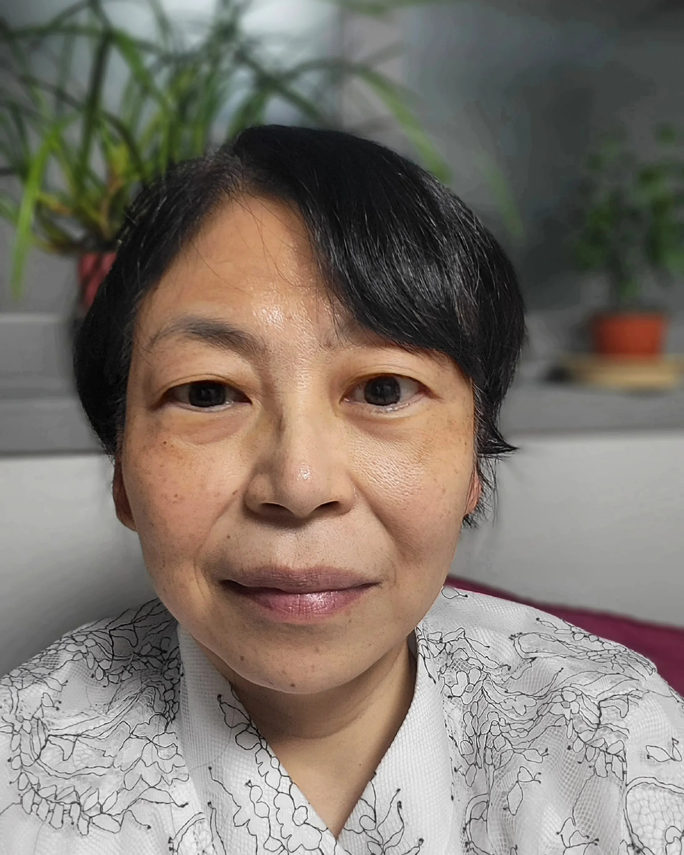 시술 전 — 미케이 피부색소 지우개