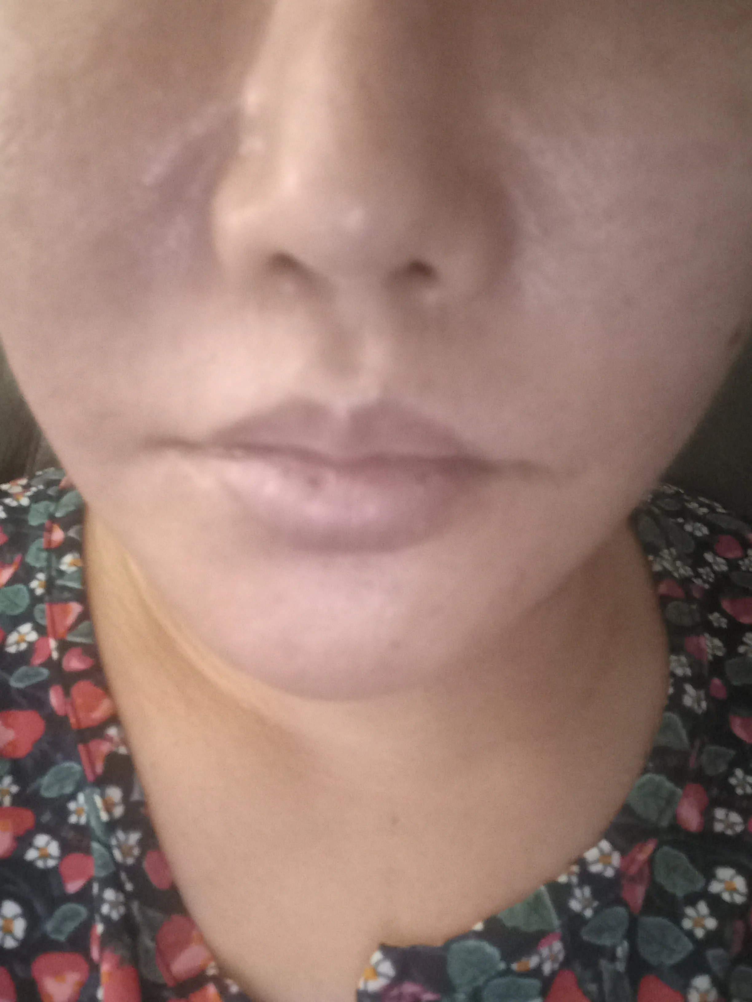 Before treatment — [First Visit Event] Contour Botox