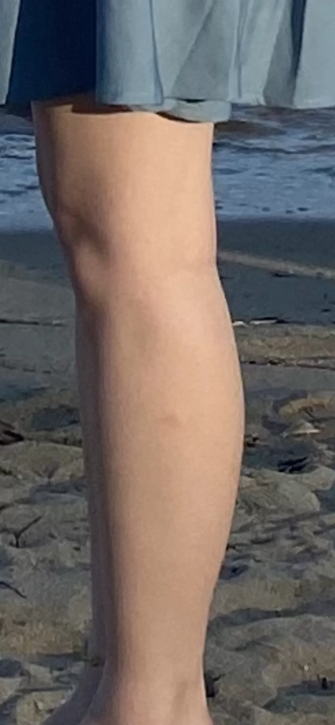시술 전 — 바디보톡스/다한증 보톡스