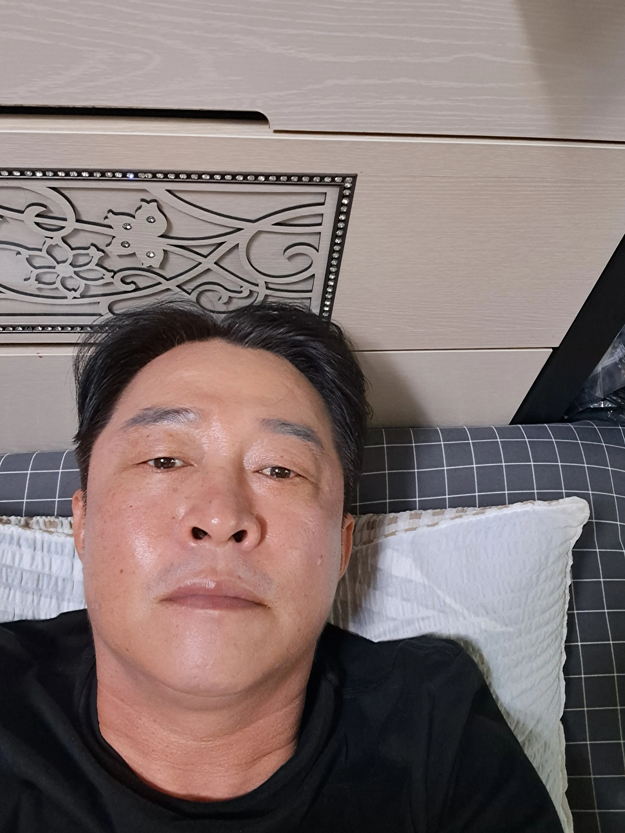 시술 후 — 팔자필러 1cc 3.8만원
