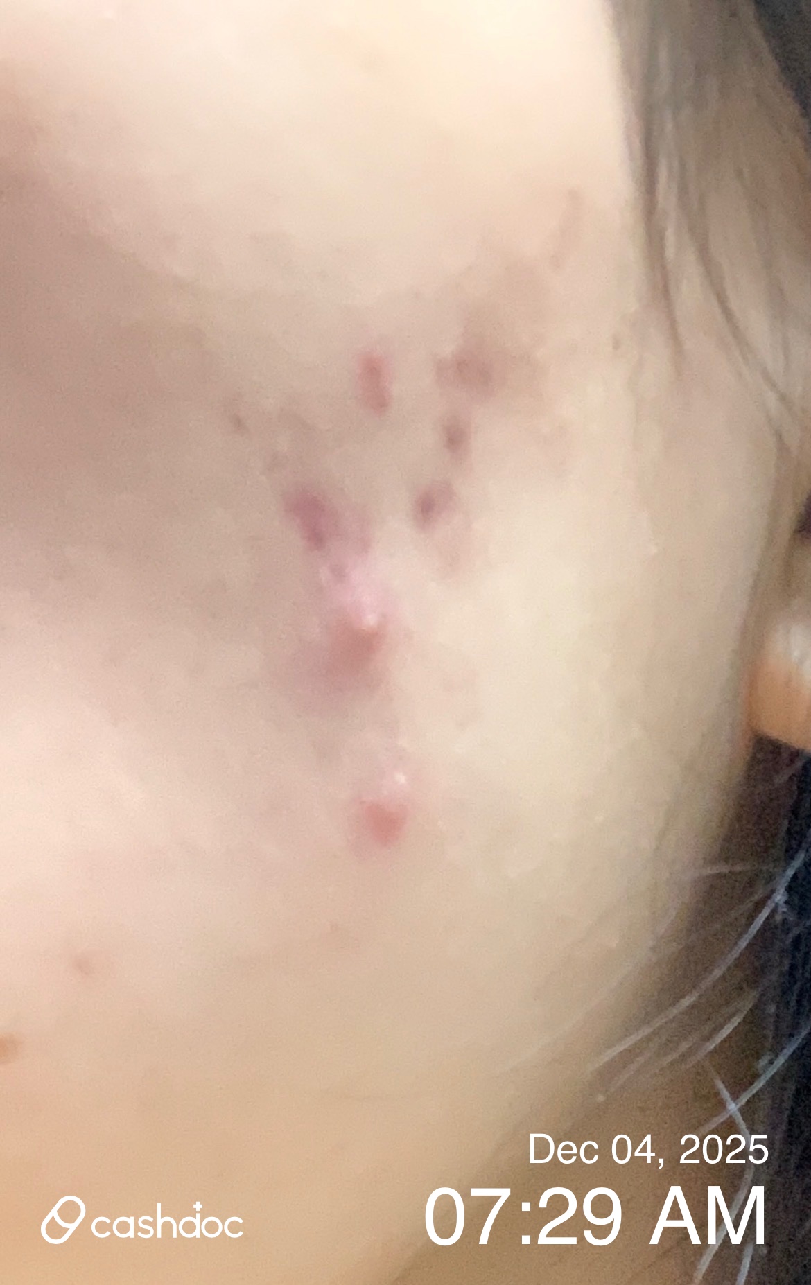 계피부과의원에서 겪은 트러블 피부 회복기: 주말보다는 평일 오전이 대기 시간 짧아요