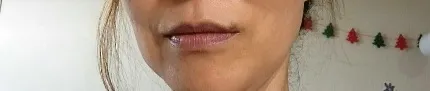 시술 후 — 오썸 디자인 입술필러