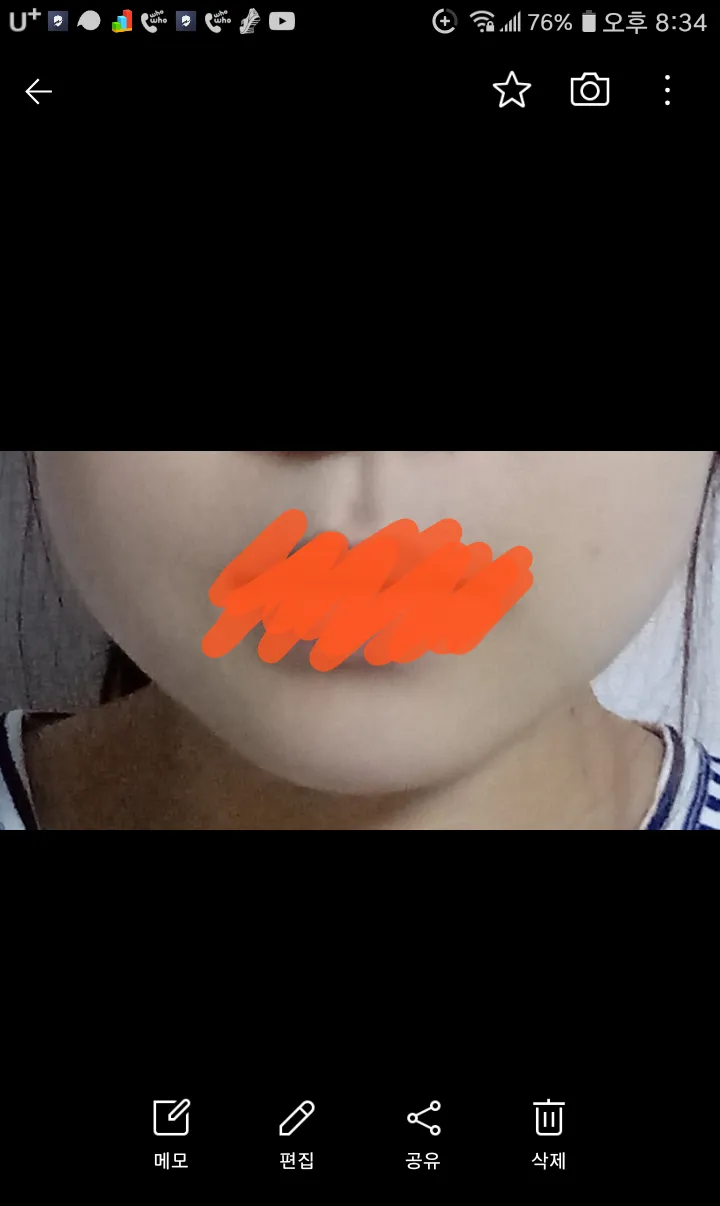 시술 전 — 브이핏 윤곽주사 이벤트