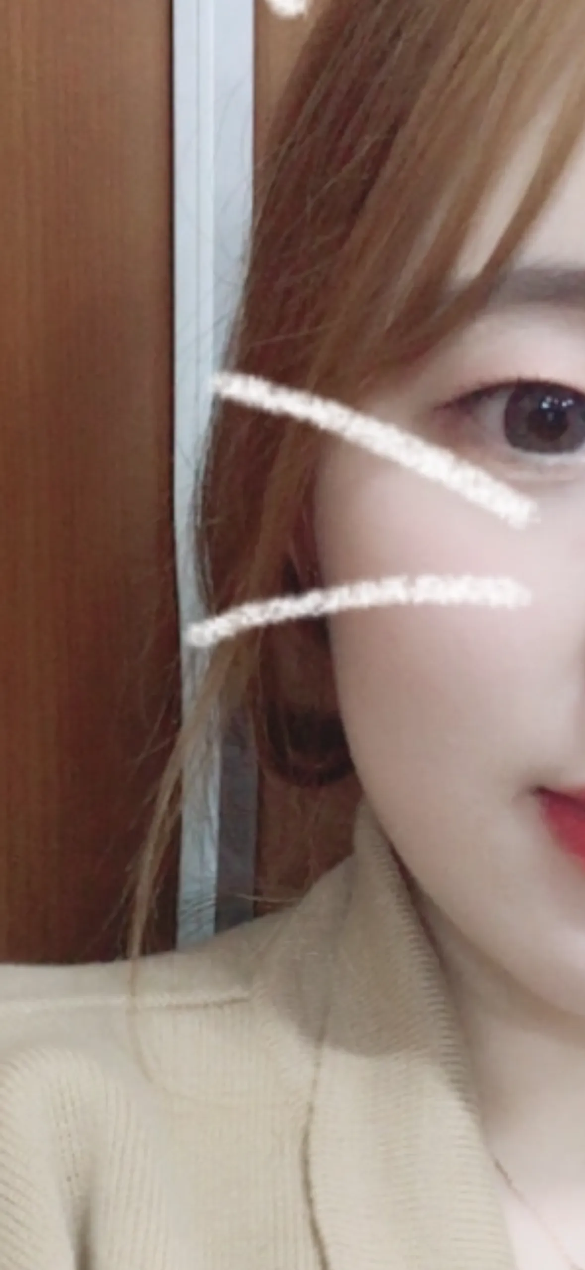 시술 전 — 튀어나온 턱라인 정리. 침샘보톡스