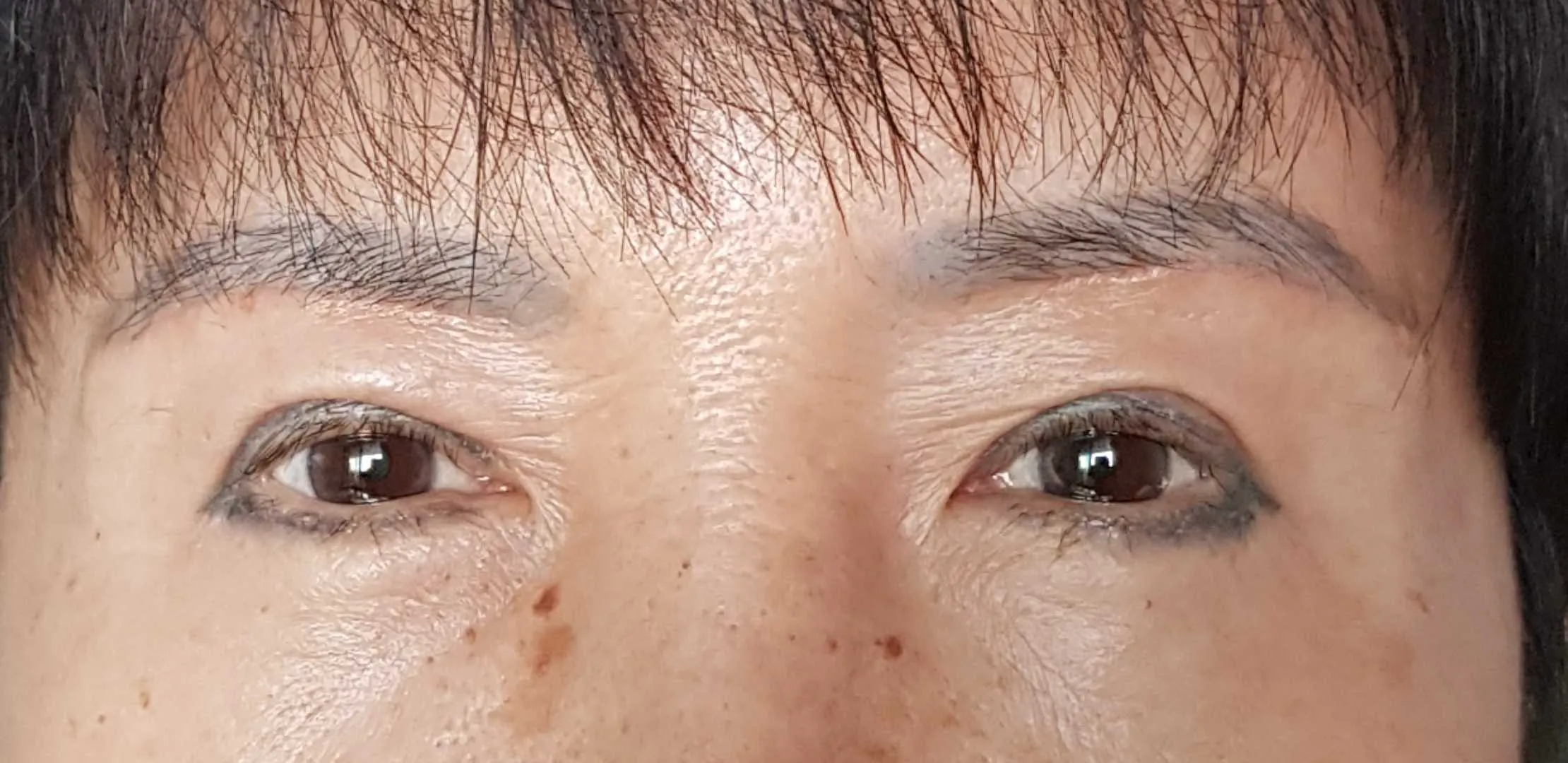 시술 후 — 눈성형~ 또렷하게 예쁜눈 