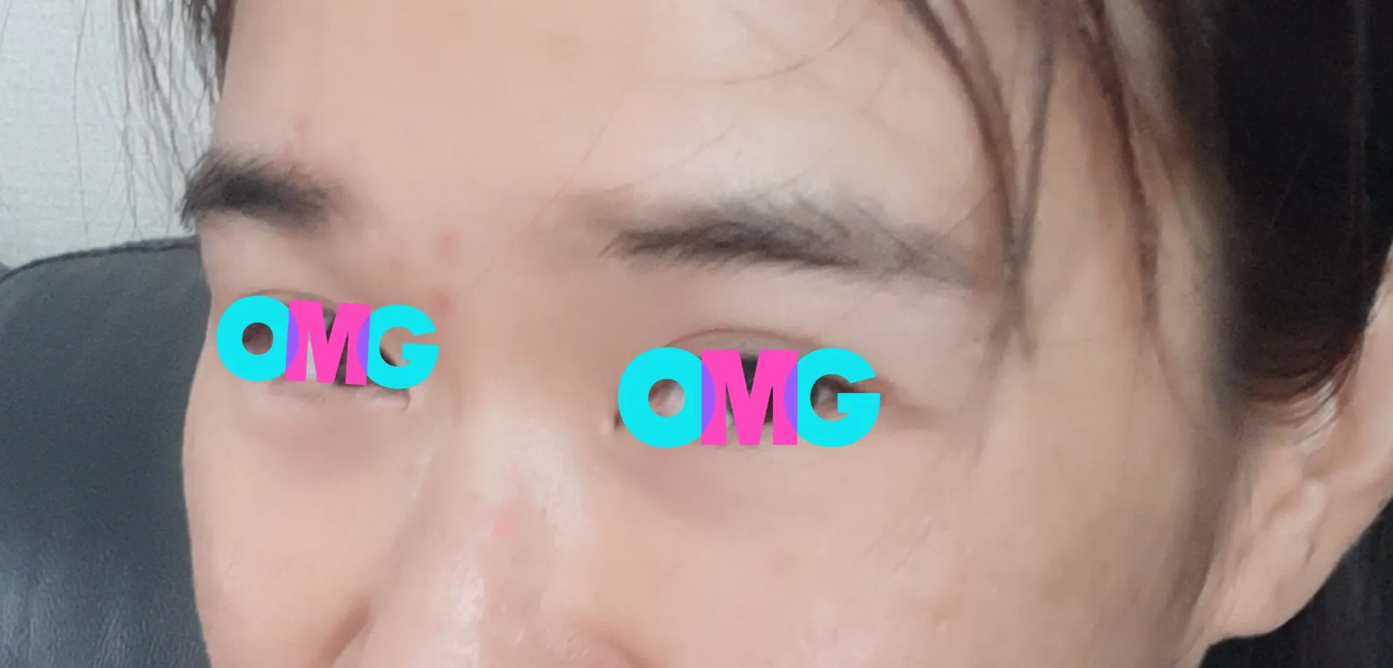 시술 전 — 잘~빠진 민트 하이코!