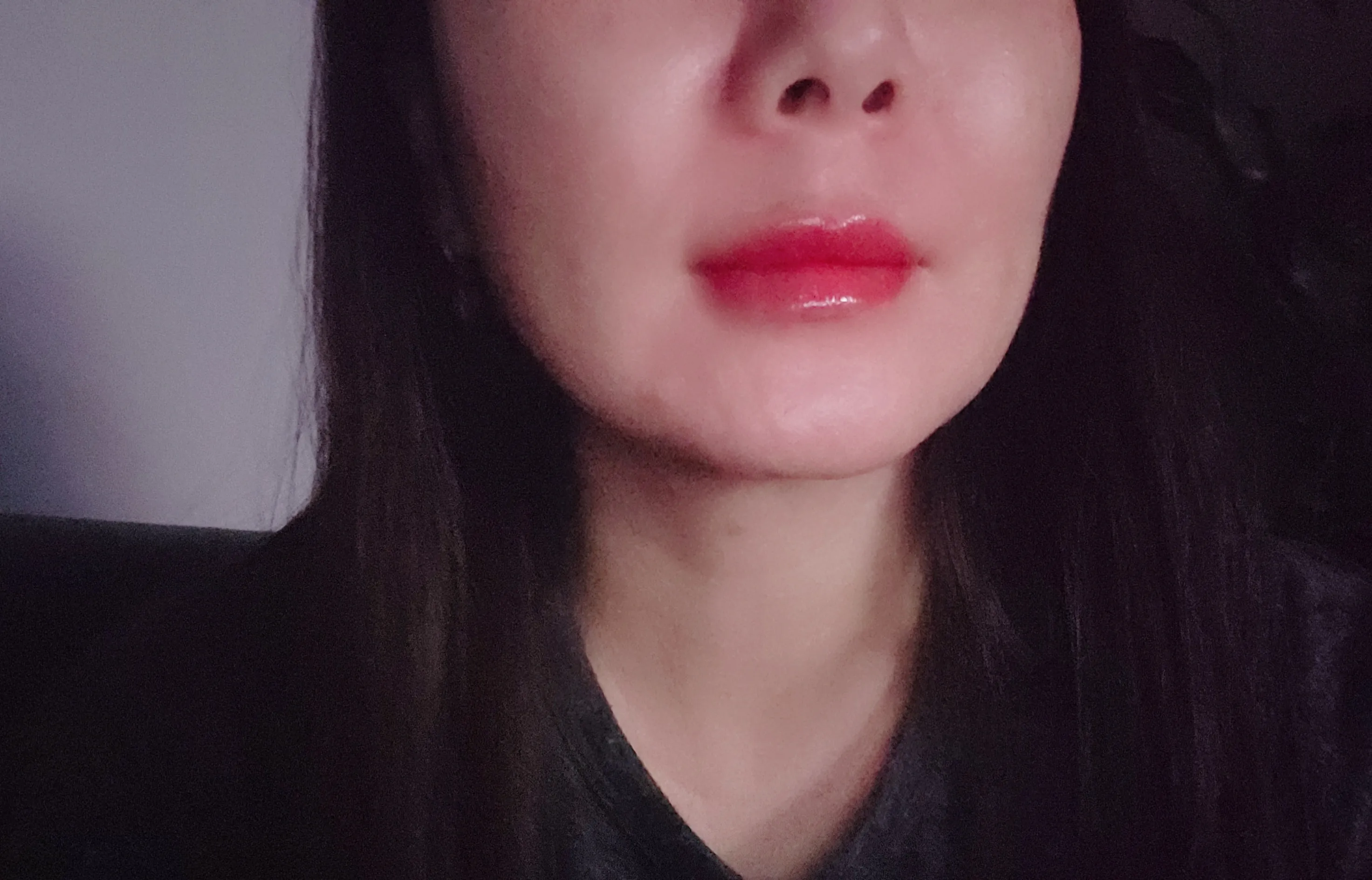 시술 전 — 미케이 피부 탄력개선_슈링크 300샷