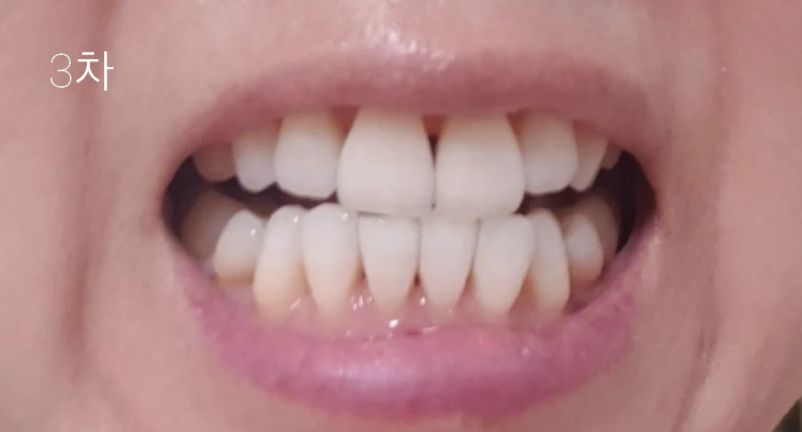 After treatment — 30-Minute Complete Teeth Whitening Program