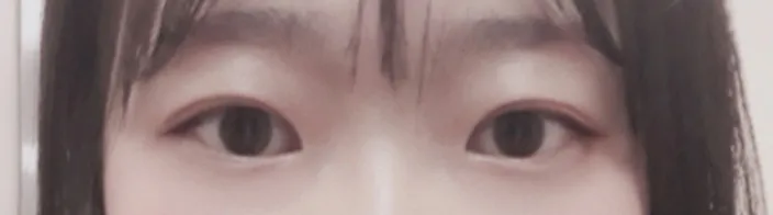 시술 후 — 눈성형~ 또렷하게 예쁜눈 