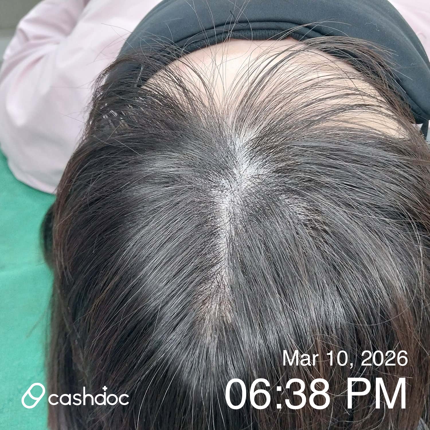 남동구 연세모벨르의원에서 탈모 초기치료 경험 후기