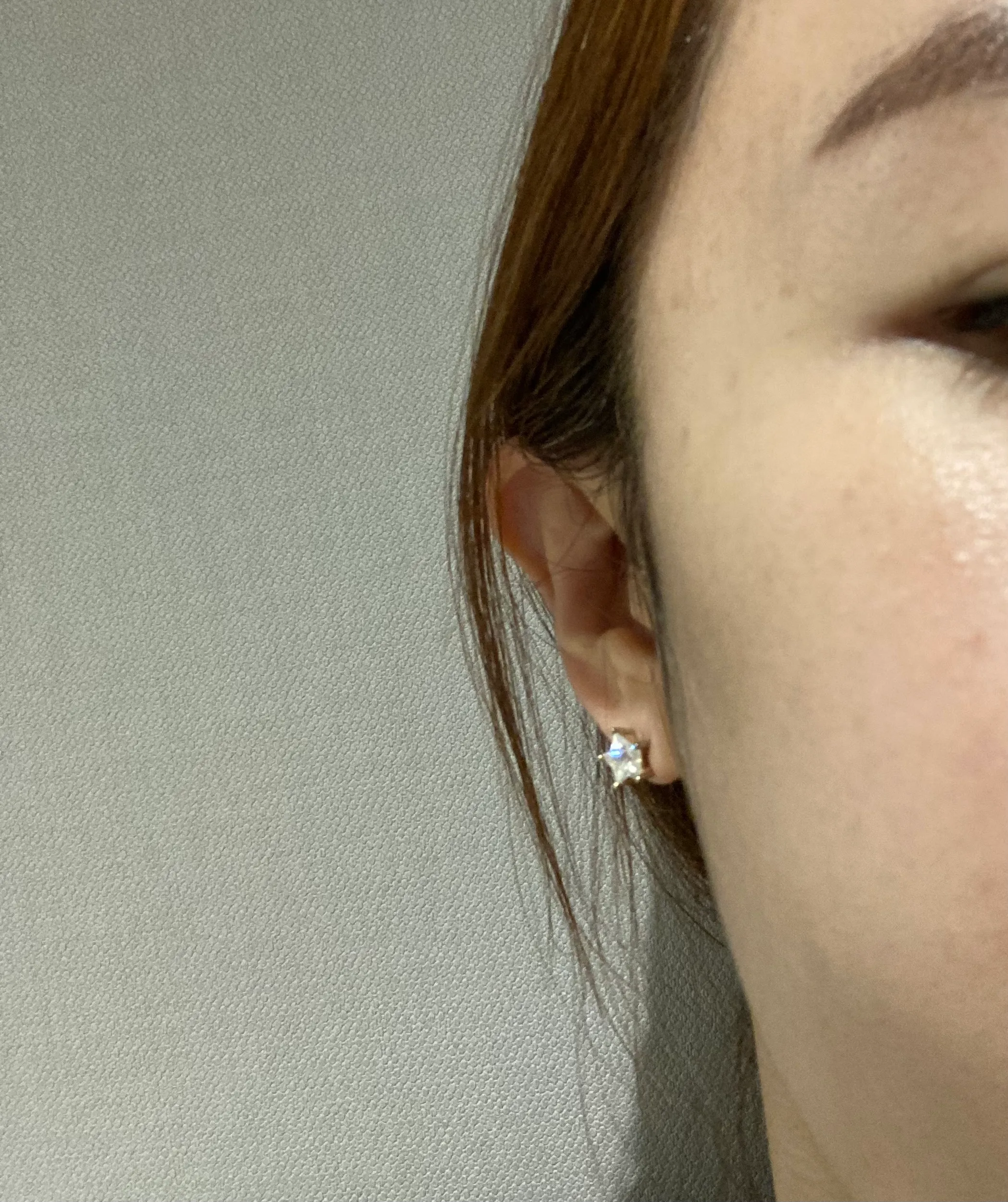 시술 전 — 튀어나온 턱라인 정리. 침샘보톡스