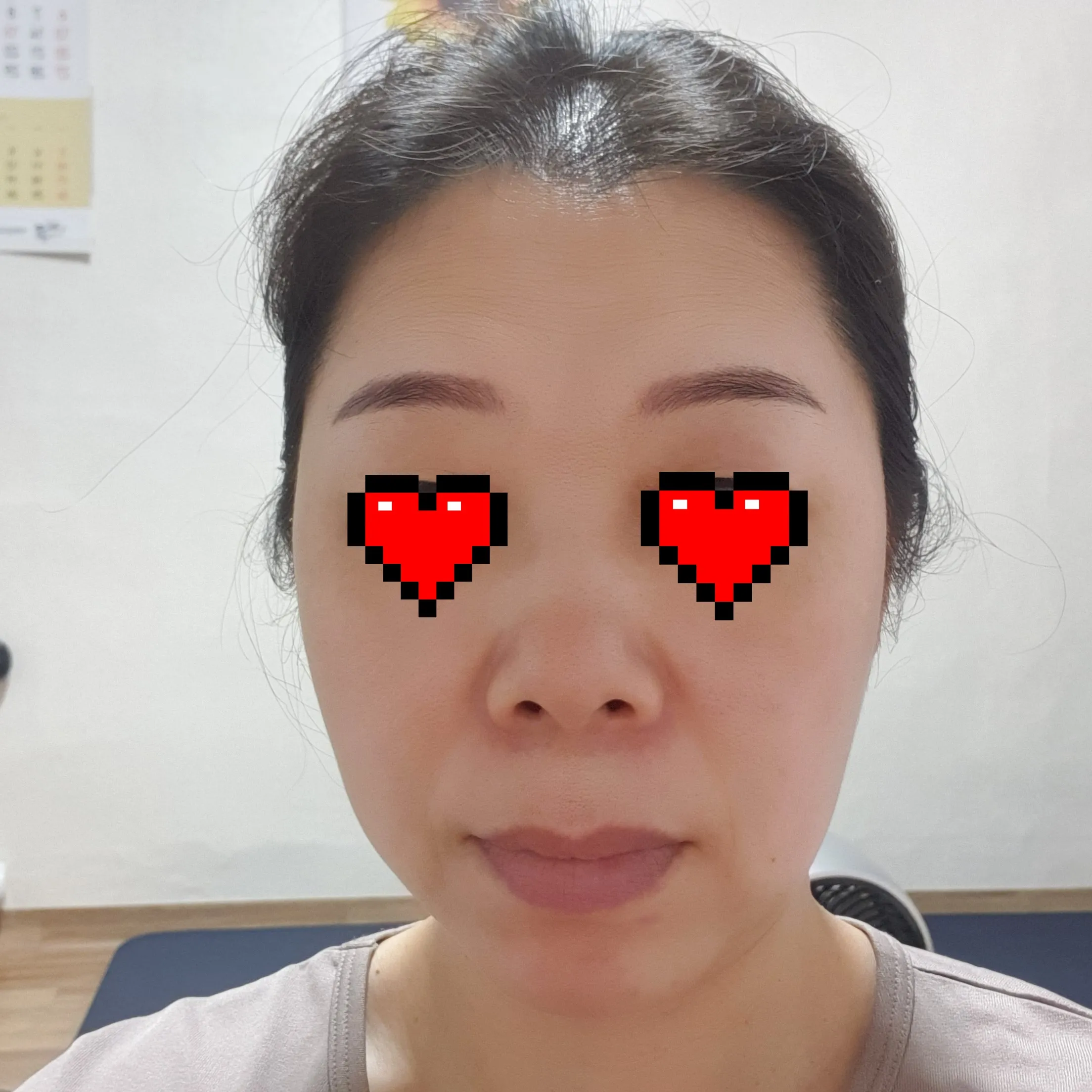 시술 후 — 기미/색소 완벽파괴! #대세 피코토닝