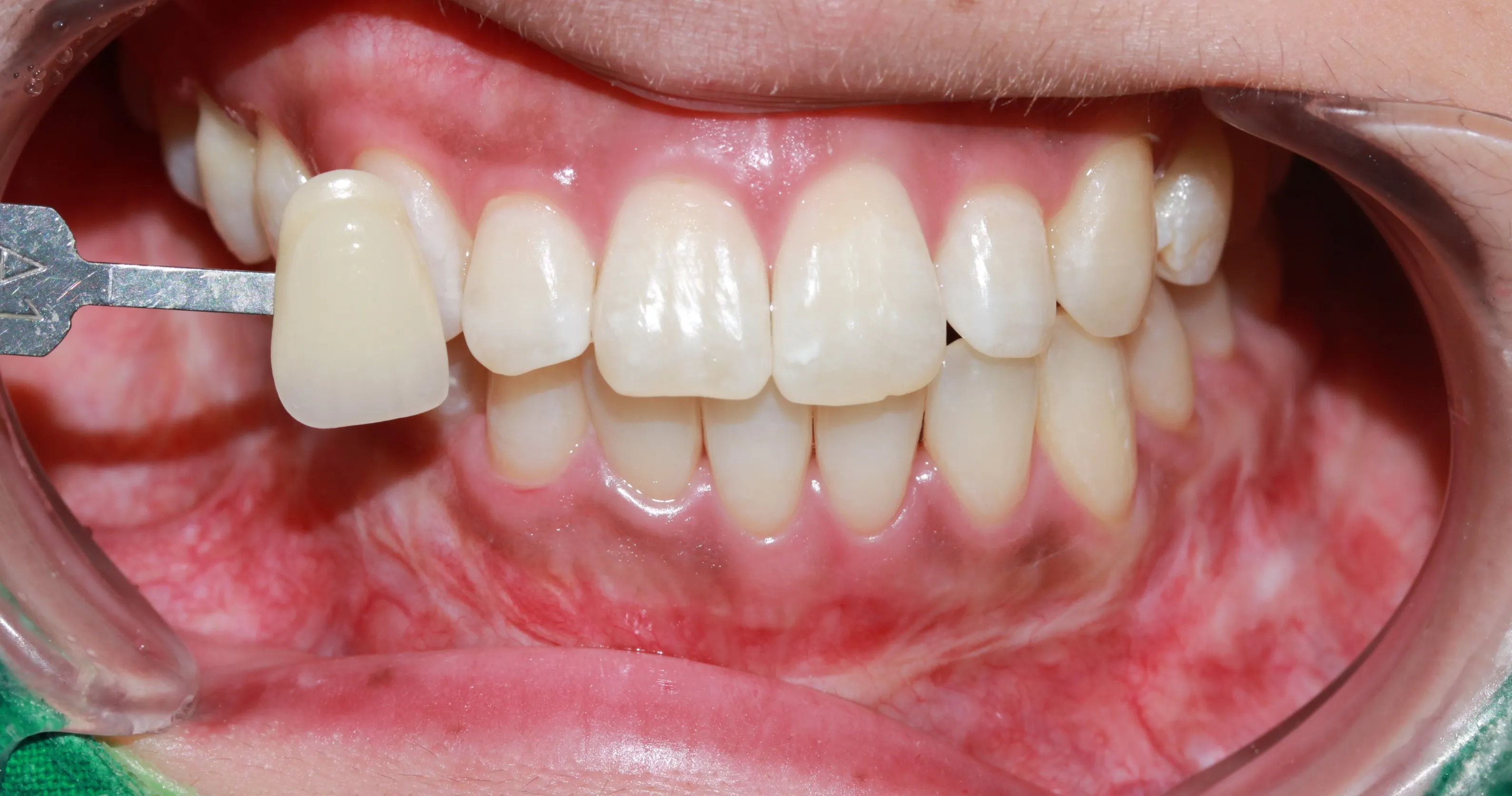 After treatment — 30-Minute Complete Teeth Whitening Program