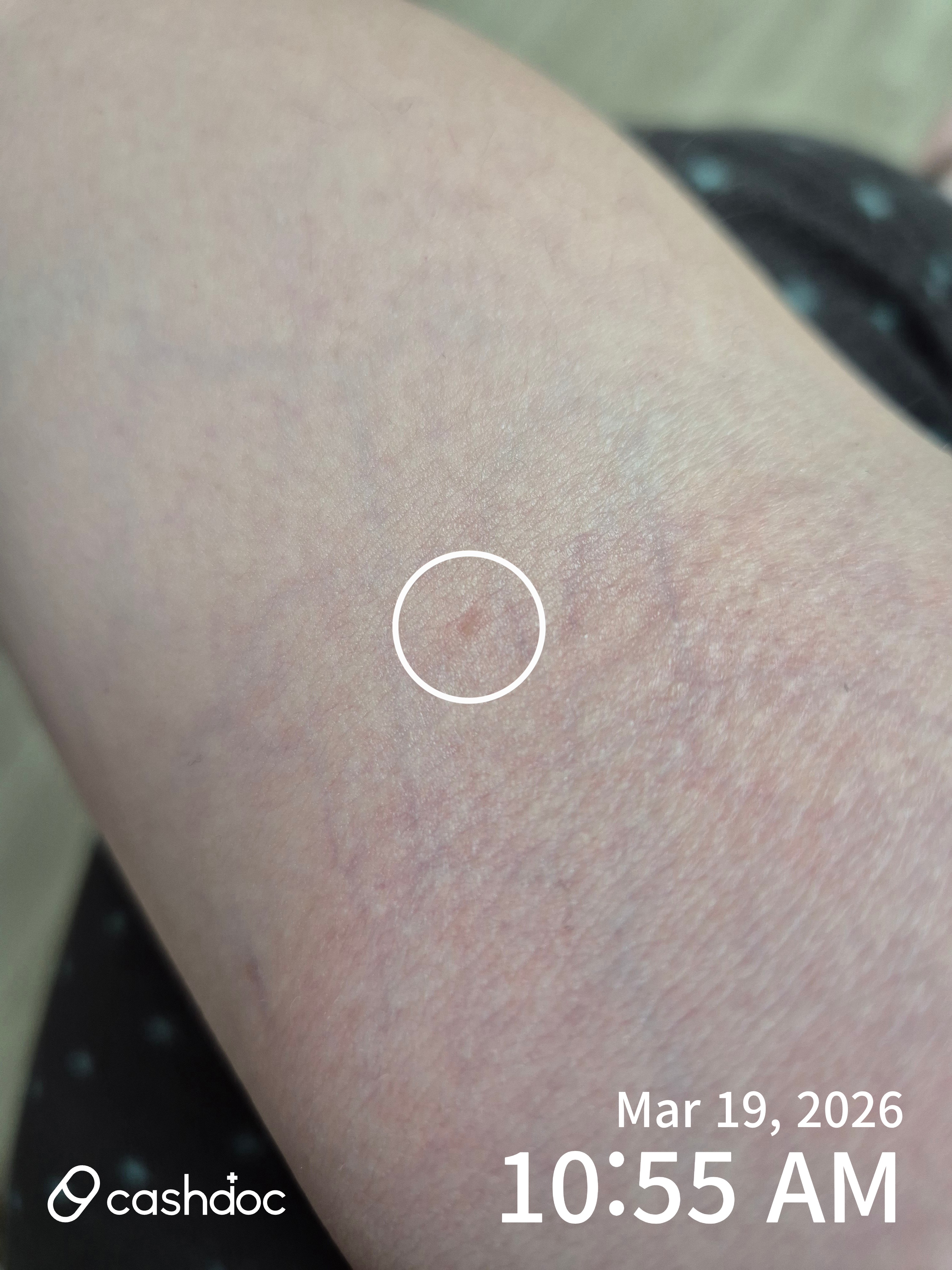 강동구 메이퓨어의원에서 편평사마귀 제거 후기: 친절하고 이벤트 많아요!