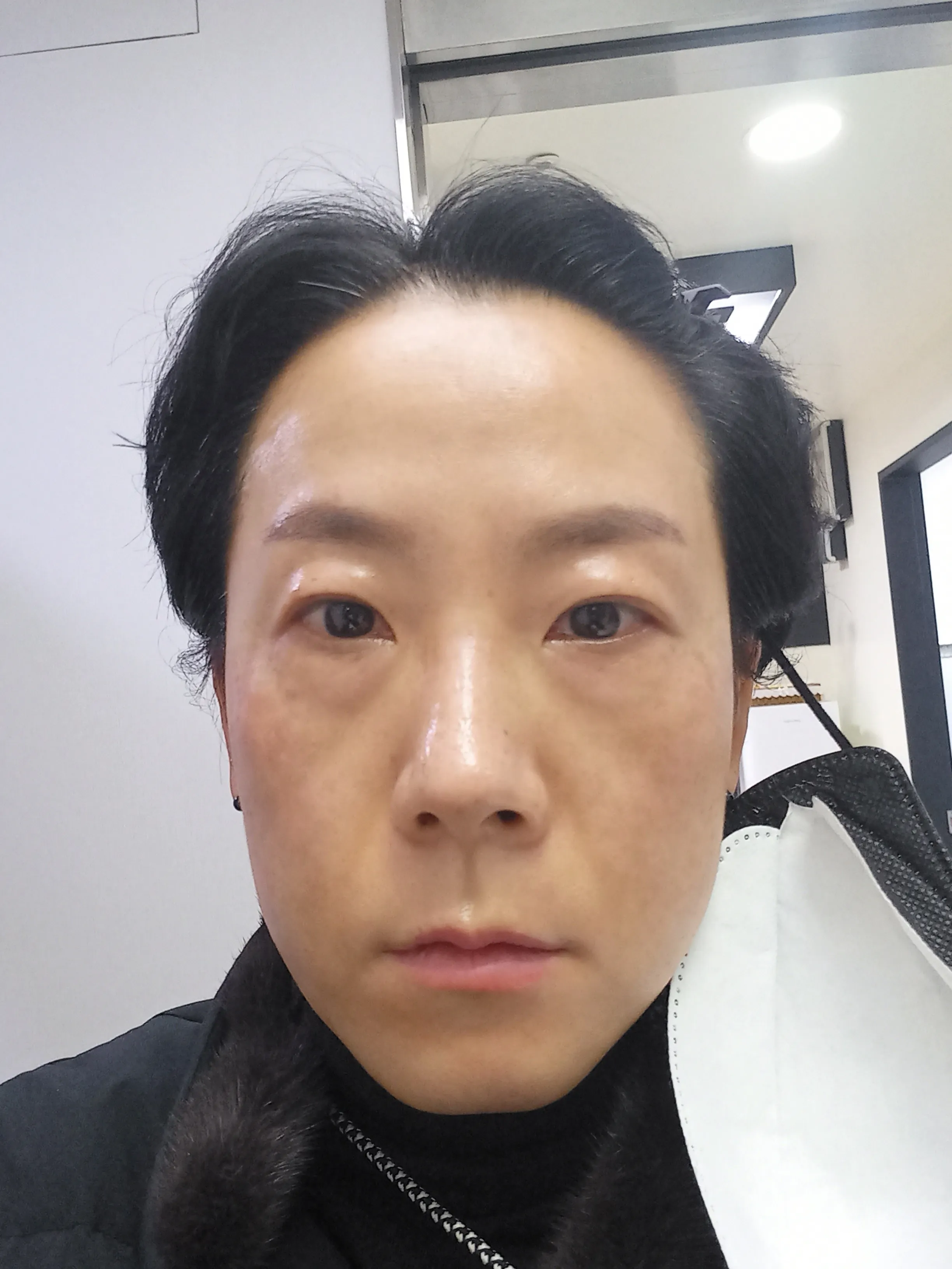 시술 후 — 미케이 피부색소 지우개