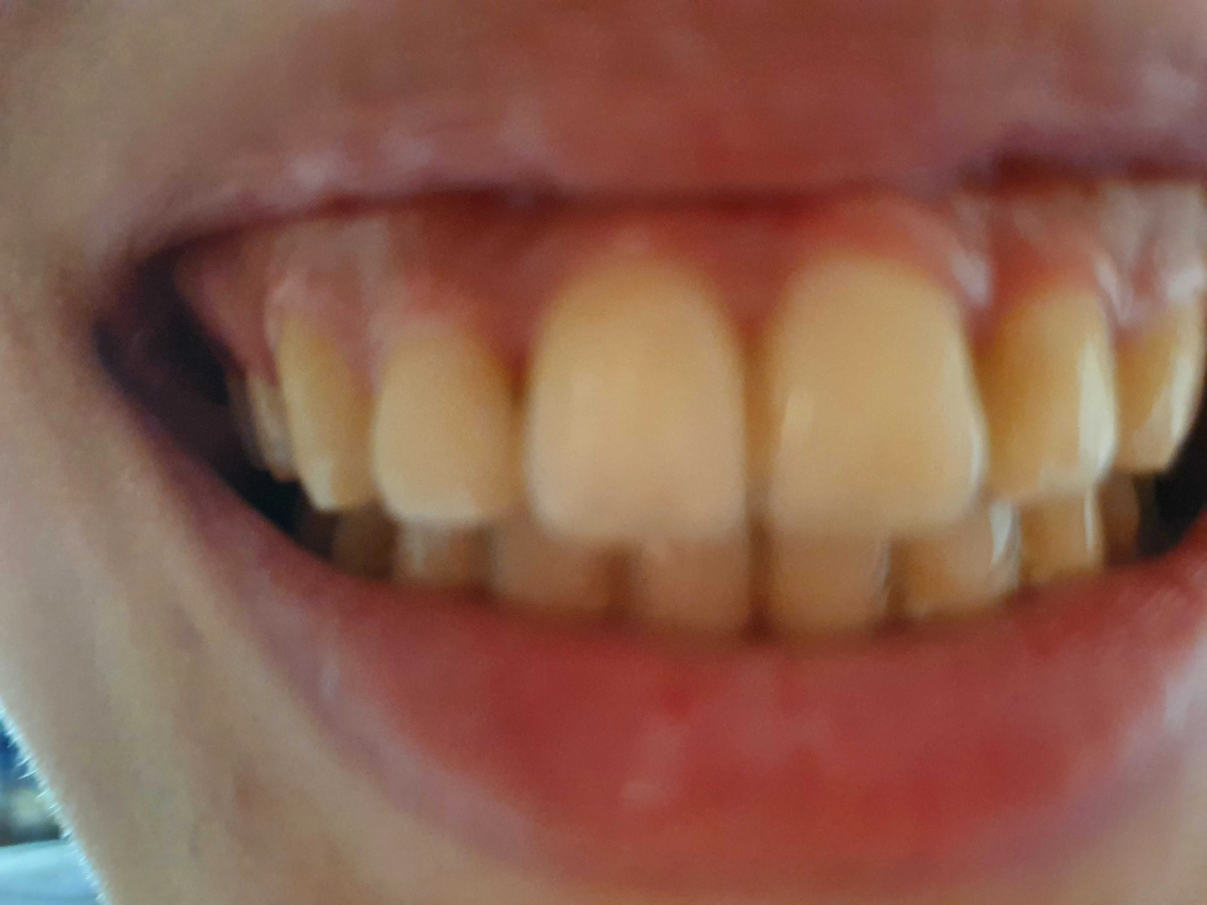 Before treatment — 30-Minute Complete Teeth Whitening Program