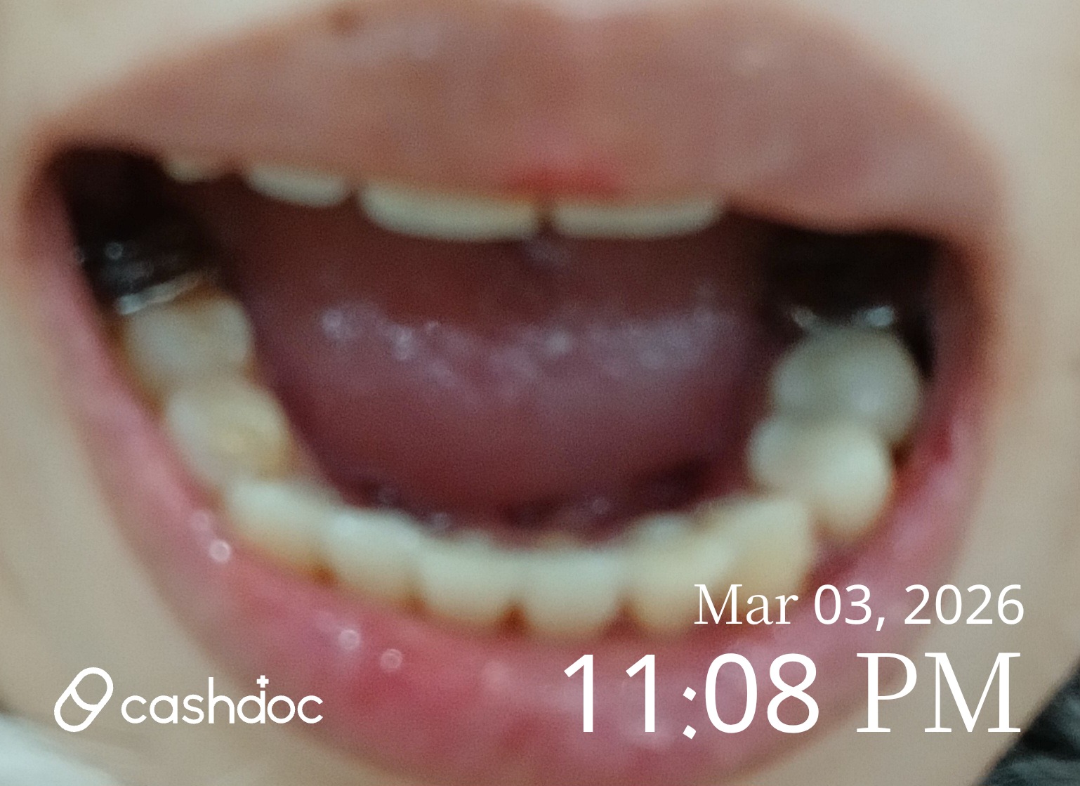 울진군 연세중앙치과의원에서 사랑니 빼기 경험 후기