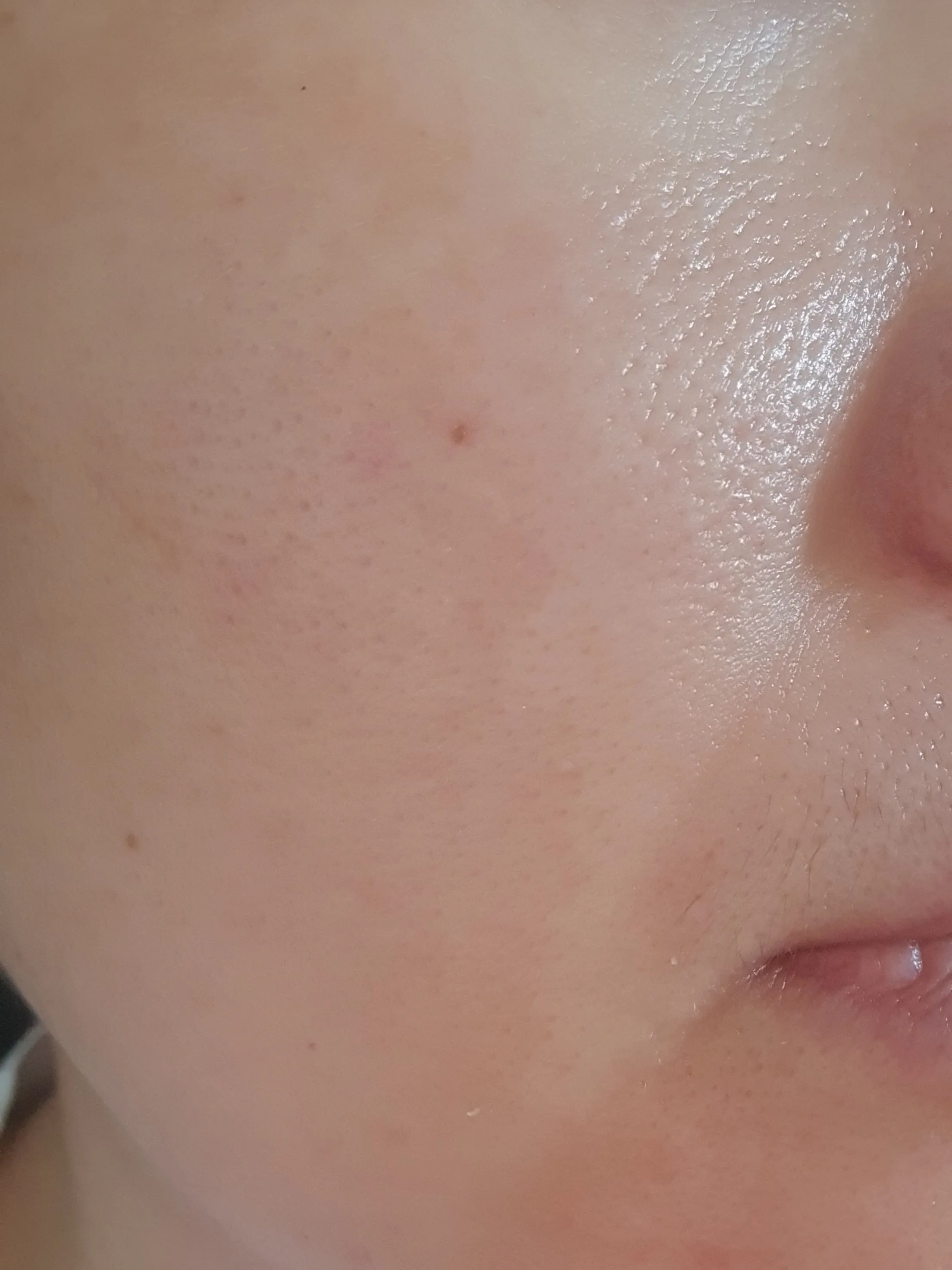 시술 후 — #뉴라덤, 더블업부스팅