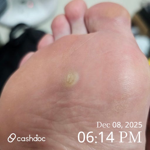 강남에서 발사마귀 치료, 오체안피부과의원 강남점에서의 친절한 상담과 냉동치료 경험