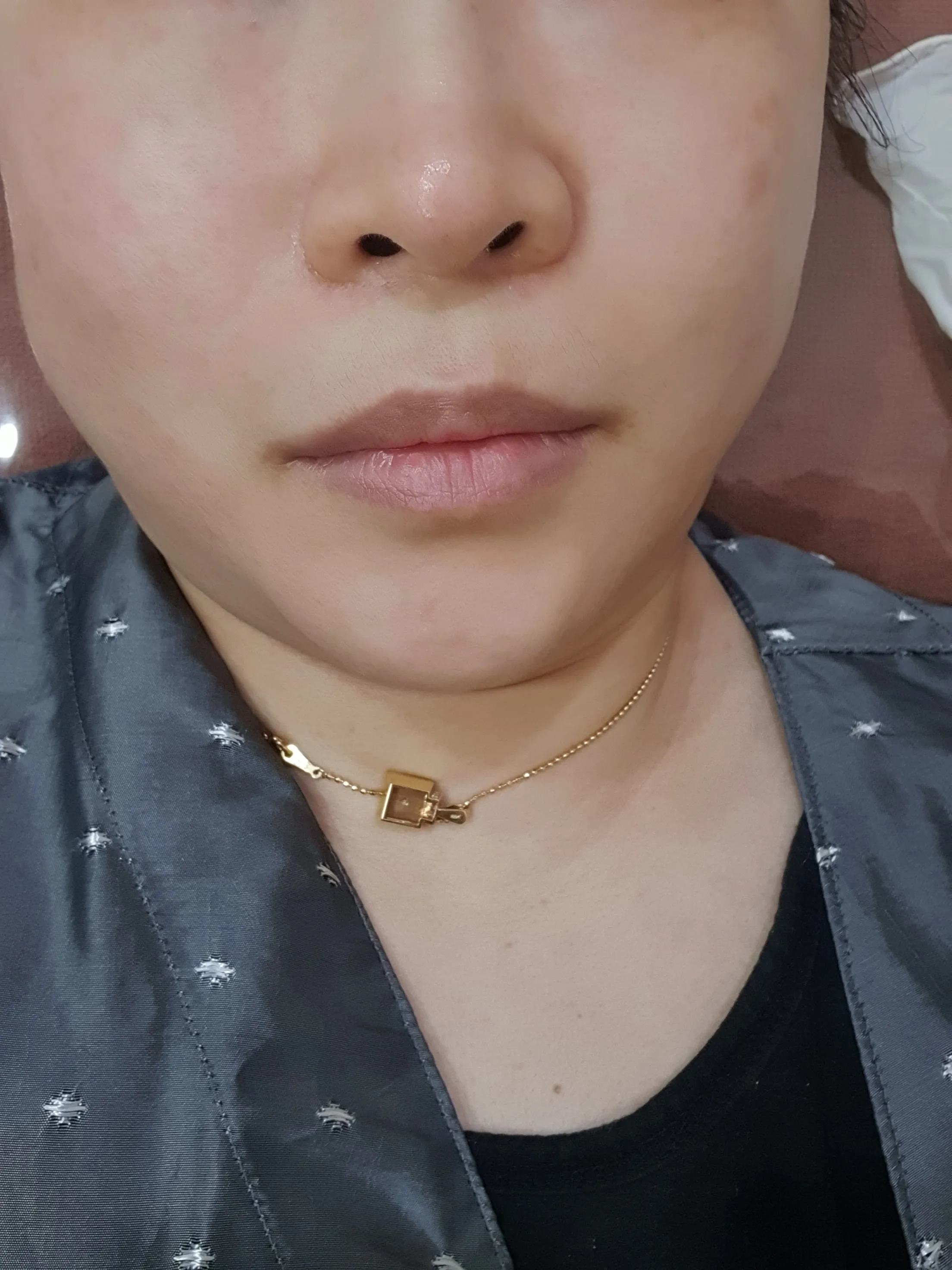 시술 전 — 미케이 넓은 모공. 여드름 흉터 개선_포텐자+LDM