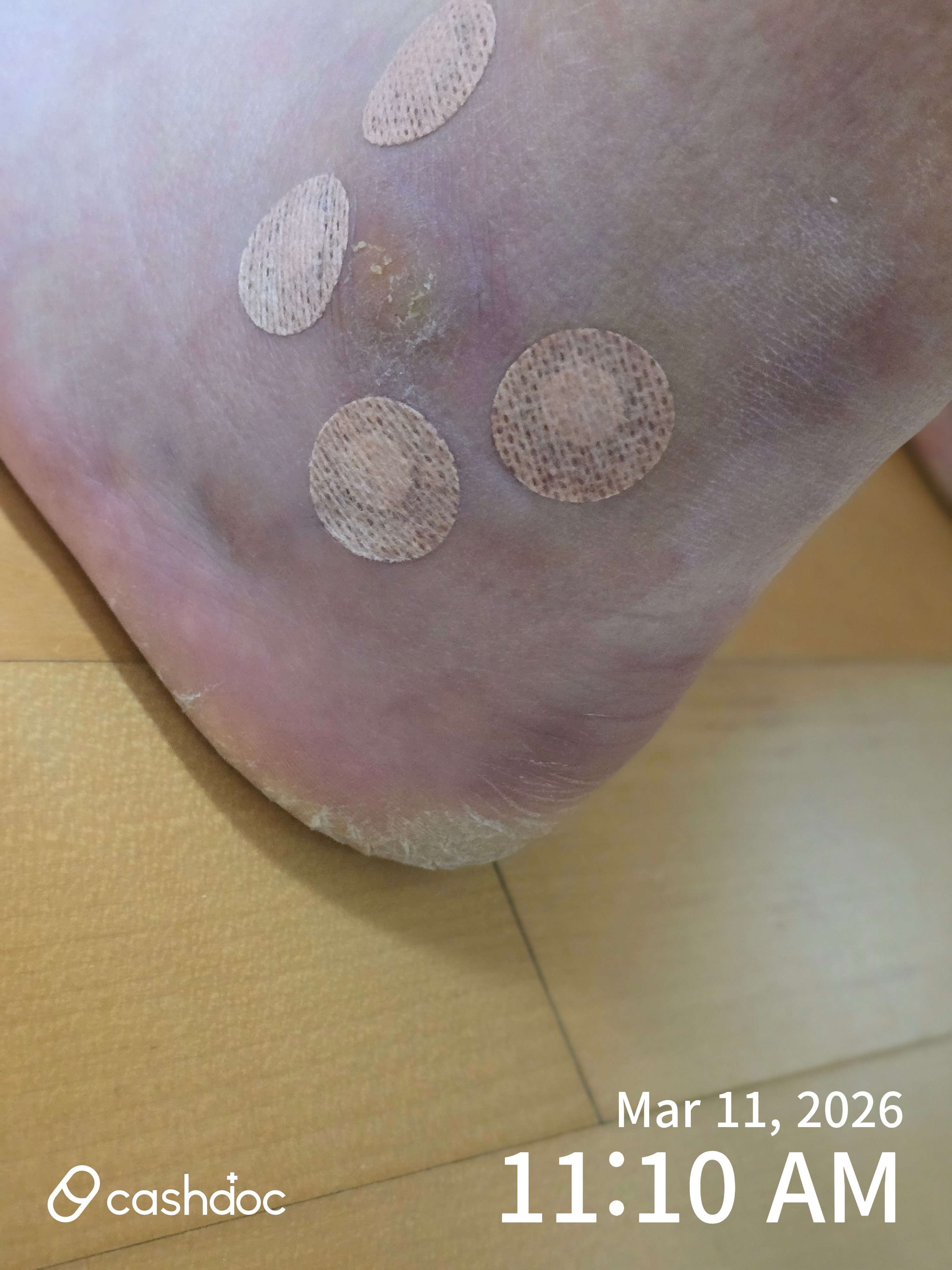 영등포구 삼성정형외과의원, 발목 주사로 바로 걸었어요!