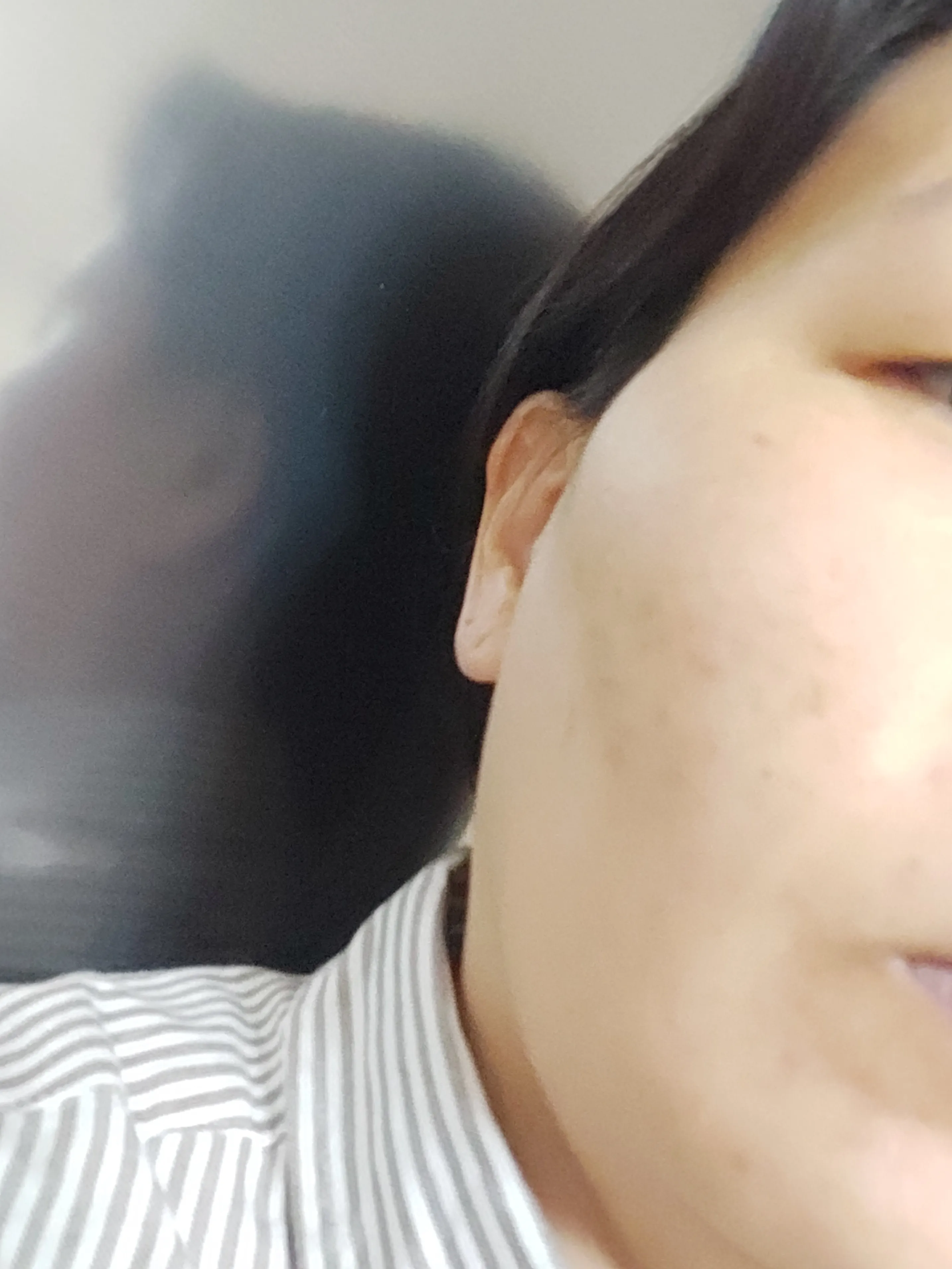 시술 전 — 노원id 피코토닝3.9