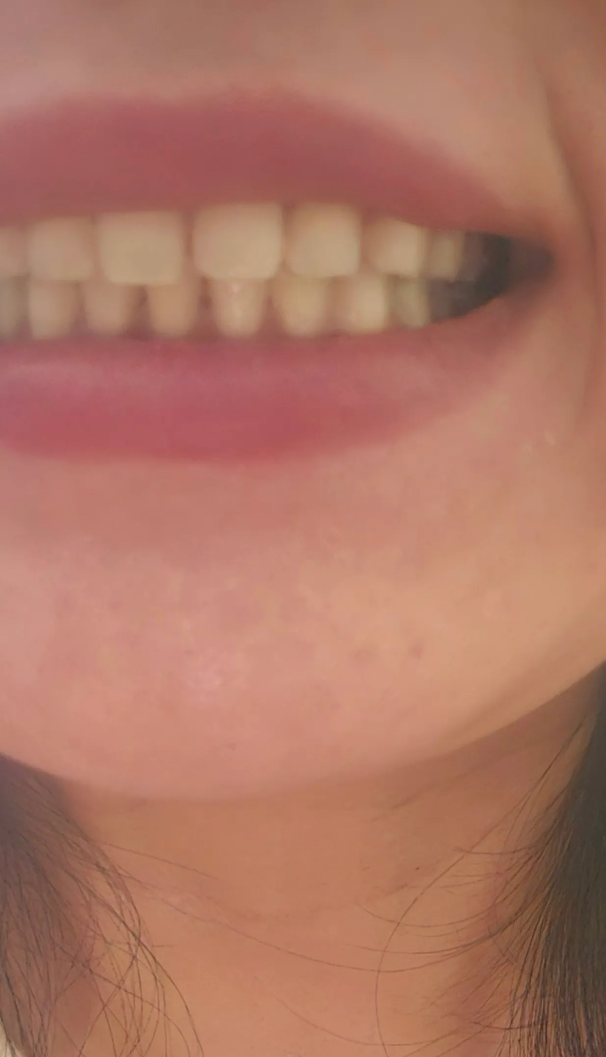 After treatment — Smart Teeth Whitening