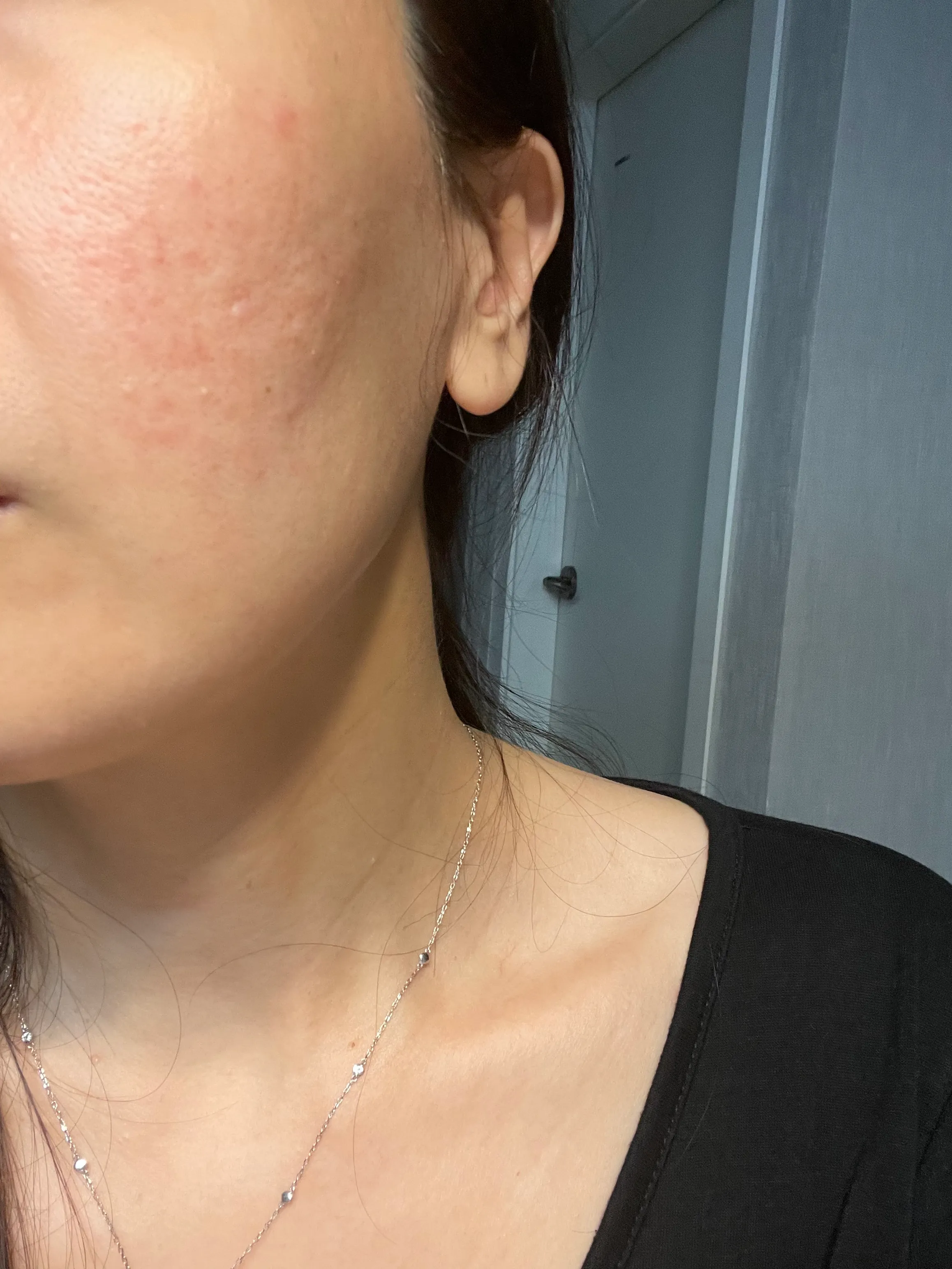 Before treatment — Have skin concerns? Try RejuAide!
