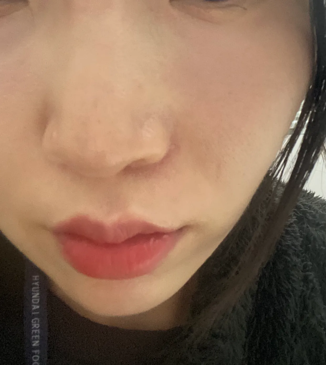 Before treatment — Pain reduction special #Rejuran Healer