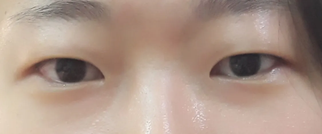 시술 전 — 눈성형~ 또렷하게 예쁜눈 