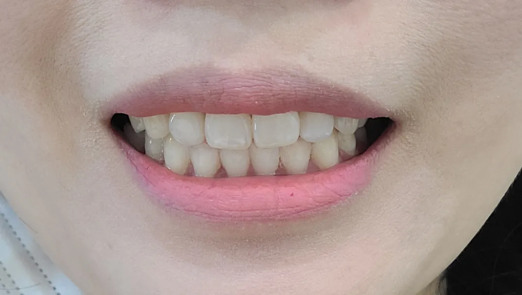 Before treatment — 30-Minute Complete Teeth Whitening Program