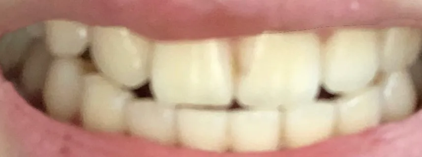 After treatment — Teeth whitening, really! ♥ 39,000 won ♥