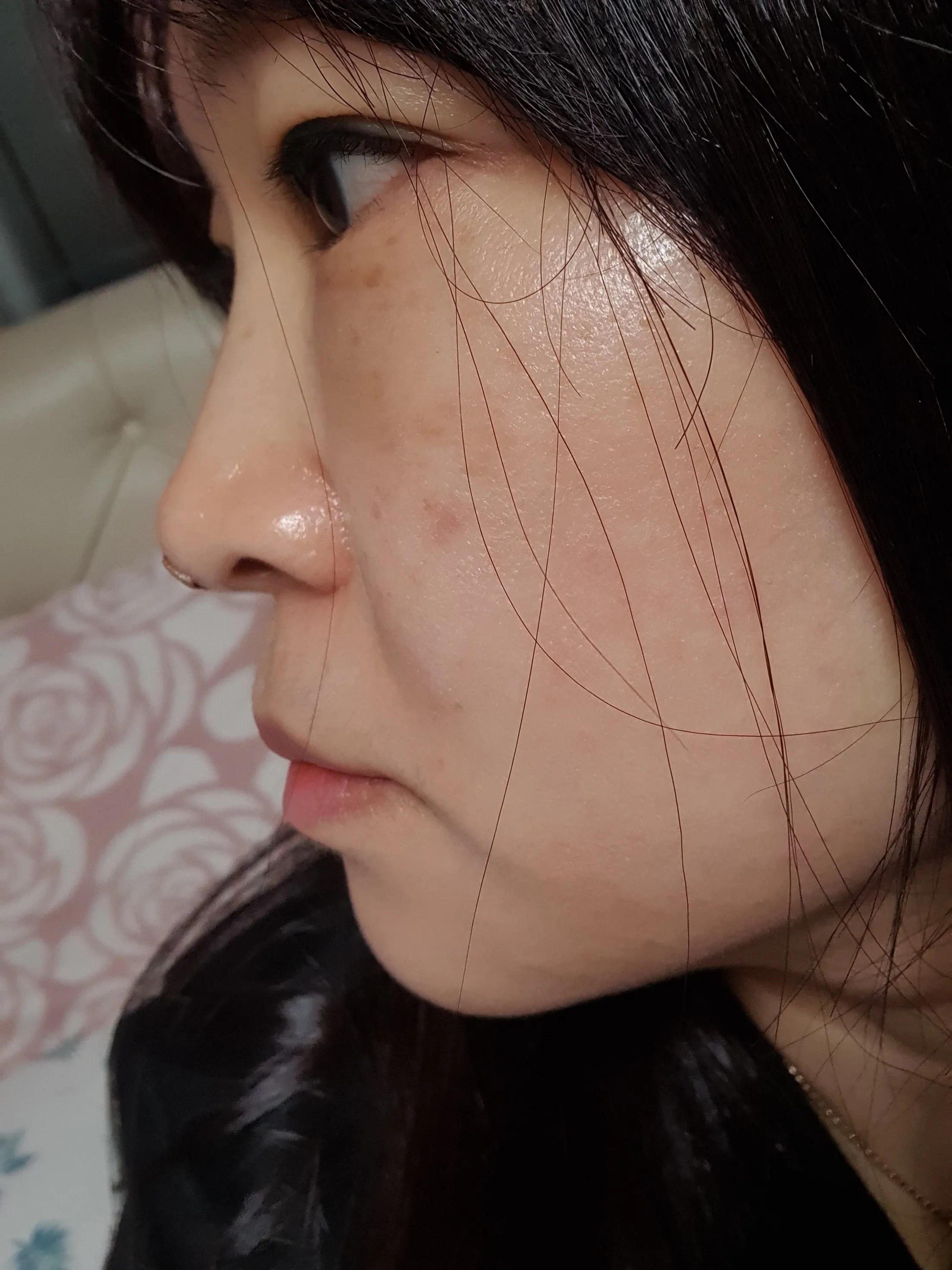 시술 후 — 피코토닝