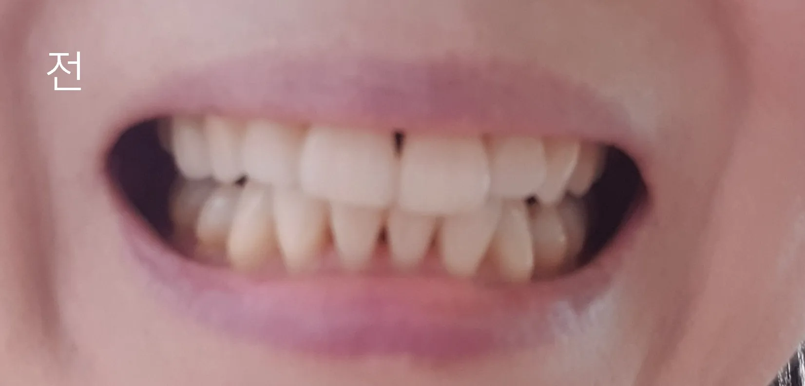 Before treatment — 30-Minute Complete Teeth Whitening Program