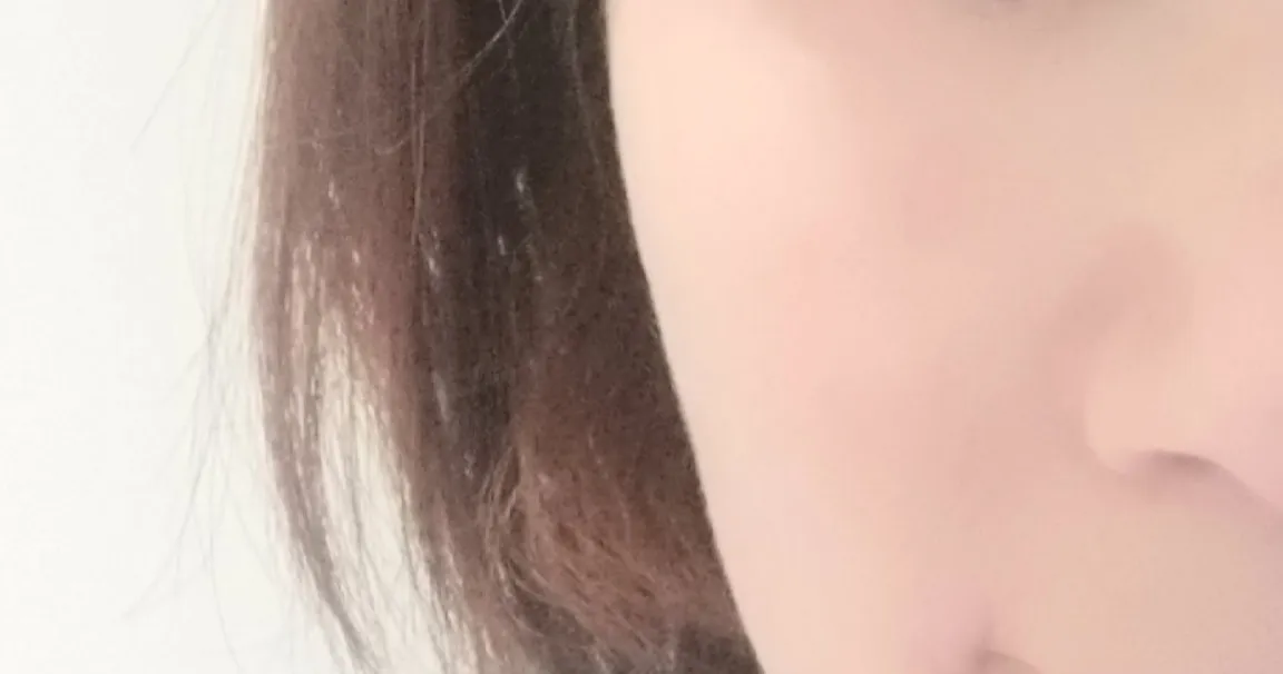 项目后 — 皮肤再生#皮肤弹性#对抗细纹的瑞姿填充剂