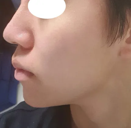 시술 후 — 잘생김에 기준! 남자 코성형