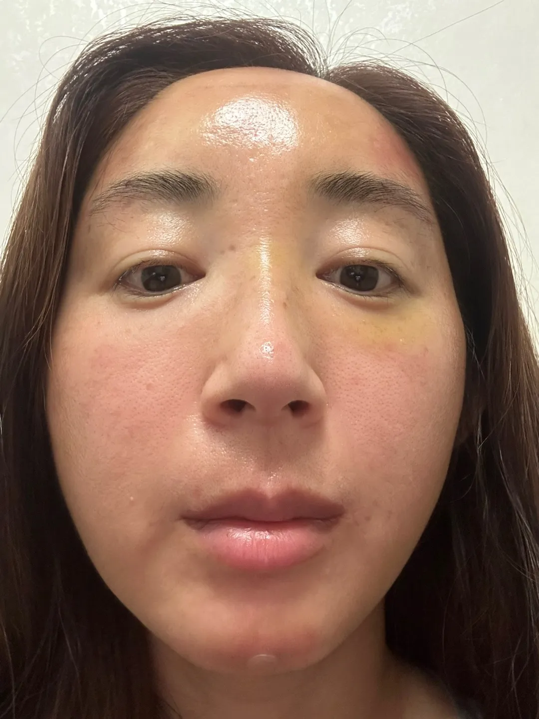 After treatment — Wonjin_Facial Contouring