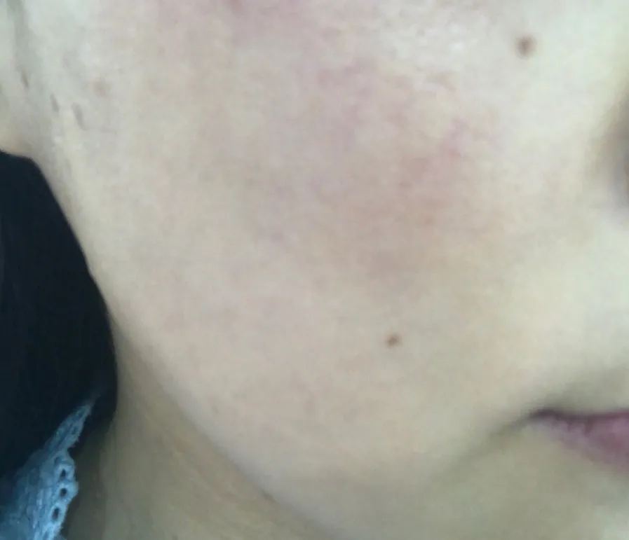 Before treatment — Pain-Reducing Special Offer #Rejuran Healer